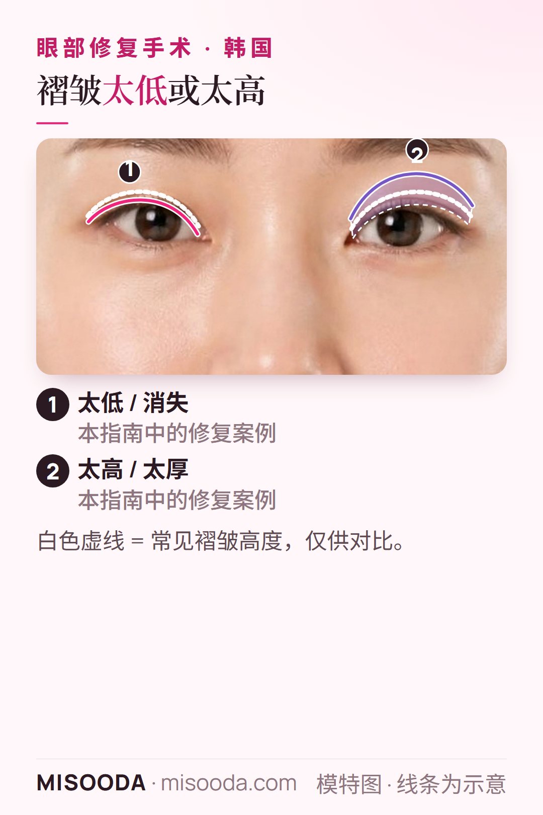 韩国 双眼皮修复双眼示意:一只眼褶皱太低或消失,另一只眼褶皱太高太厚,线条为示意