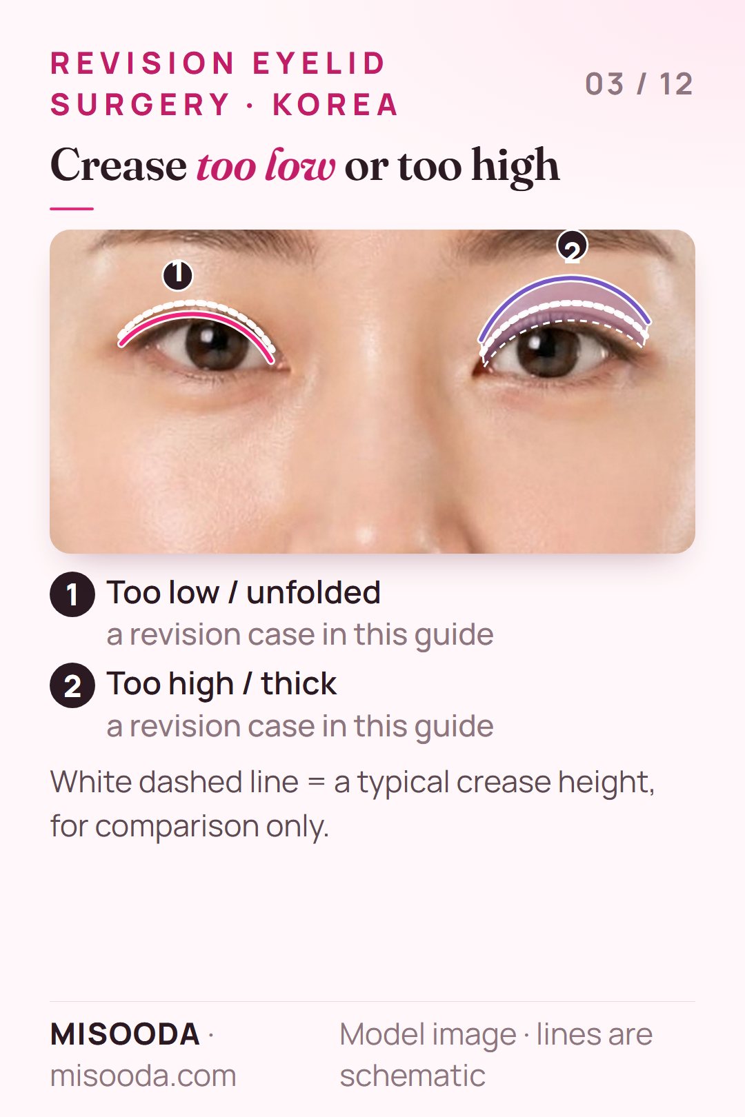 Revision double eyelid cases on both eyes: a crease too low or unfolded on one eye and a crease too high and thick on the other, schematic lines