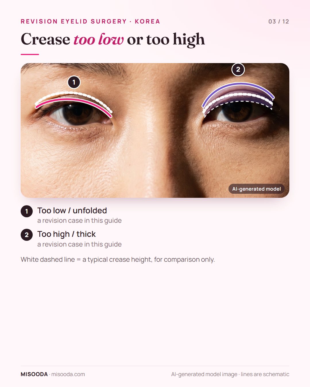 Revision double eyelid cases on both eyes: a crease too low or unfolded on one eye and a crease too high and thick on the other, schematic lines