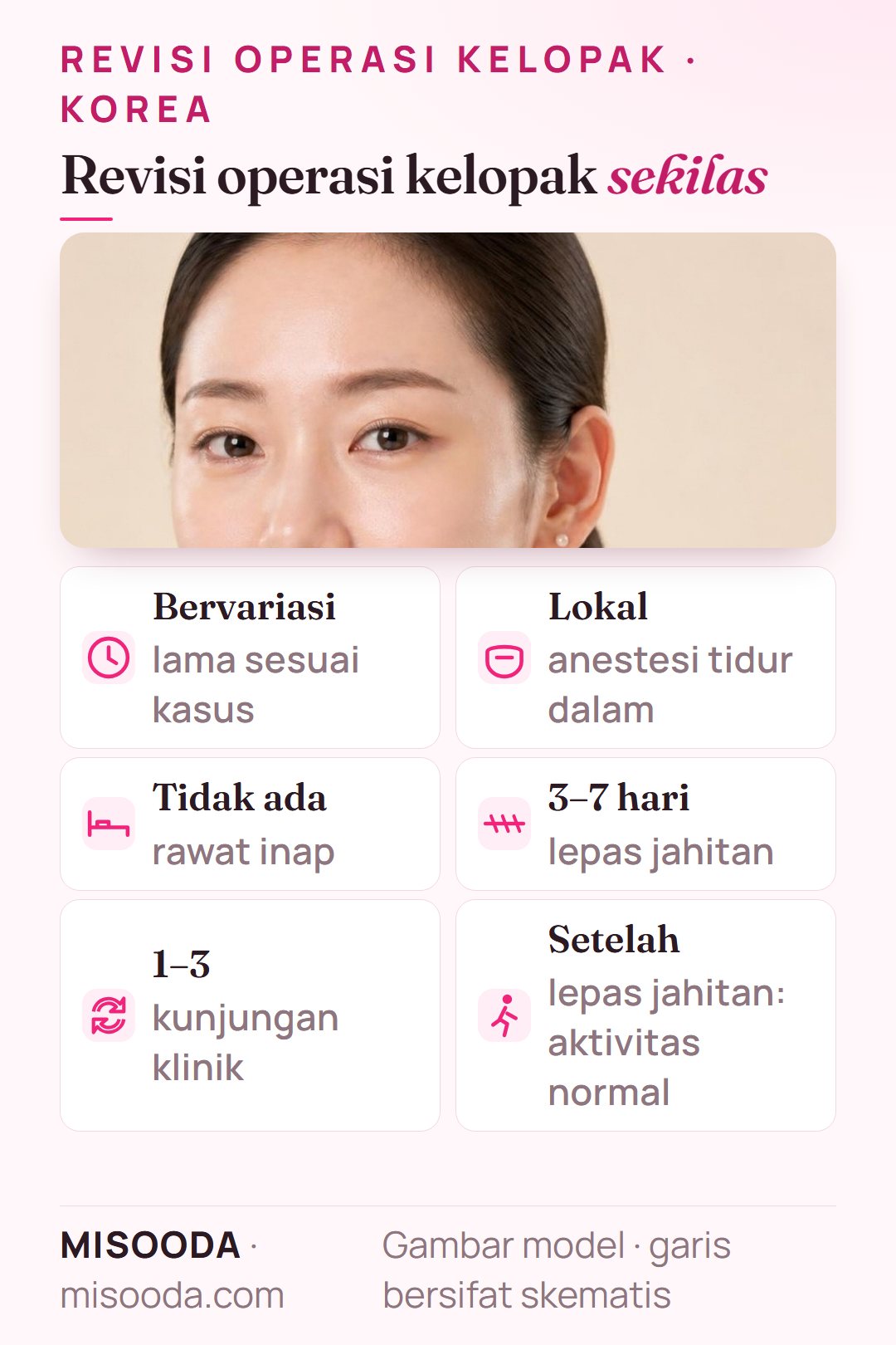 Fakta revisi operasi kelopak ganda di Korea: lama operasi sesuai kasus, anestesi lokal tidur dalam, tanpa rawat inap, jahitan dilepas dalam 3–7 hari, 1–3 kunjungan klinik