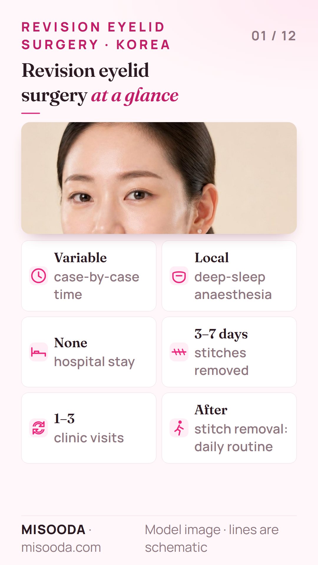 Revision double eyelid surgery facts: case-by-case operation time, local deep-sleep anaesthesia, no hospital stay, stitches out in 3–7 days, 1–3 clinic visits