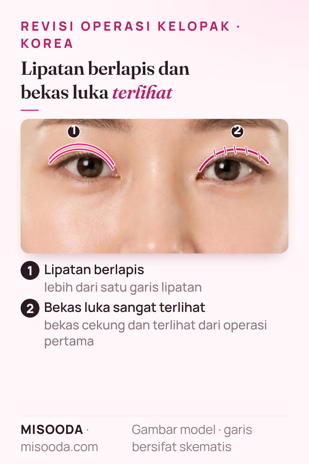 Kasus revisi kelopak ganda: lipatan berlapis di satu kelopak dan bekas luka cekung yang terlihat di sepanjang lipatan kelopak lain, ditampilkan skematis pada kedua mata