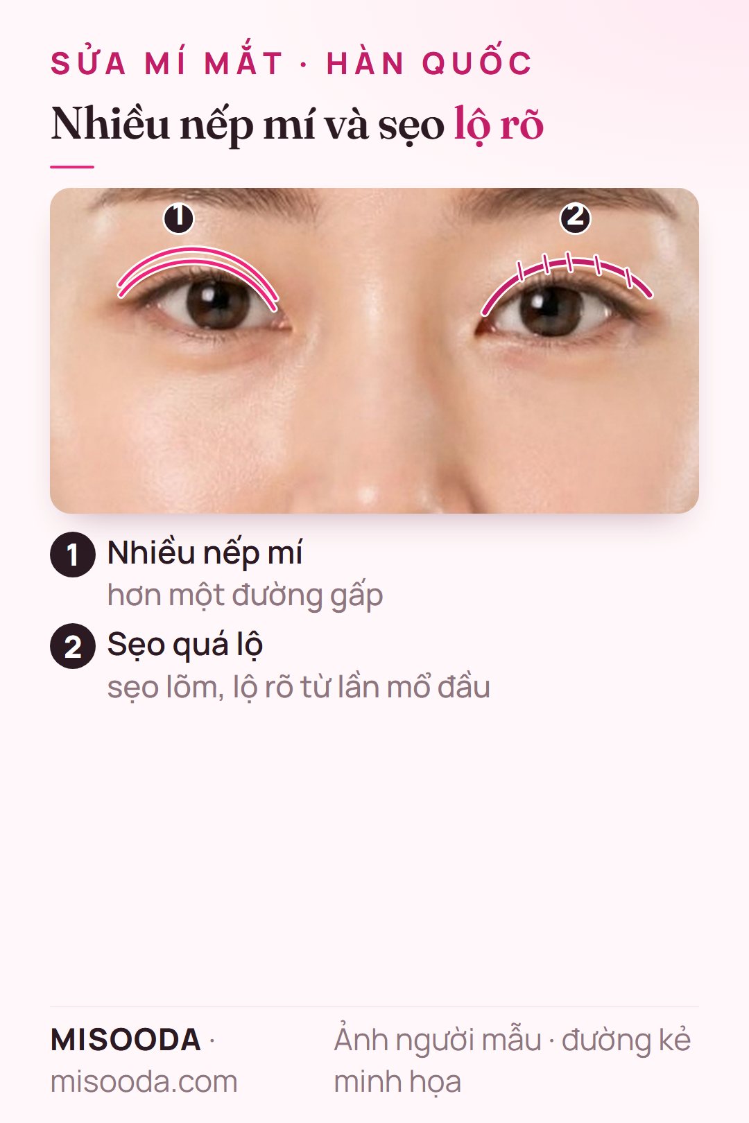 Ca sửa mí đôi: nhiều nếp mí trên một mí và sẹo lõm, lộ rõ dọc nếp mí ở mí kia, minh họa trên hai mắt