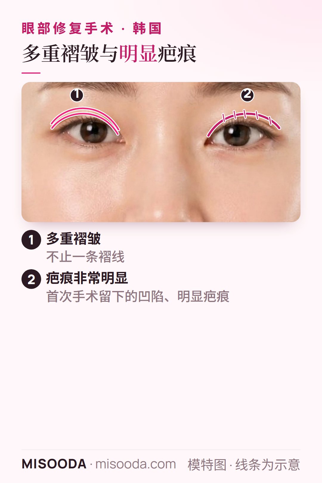 韩国 双眼皮修复案例:一侧眼睑多重褶皱,另一侧沿褶皱有凹陷明显的疤痕,以双眼示意