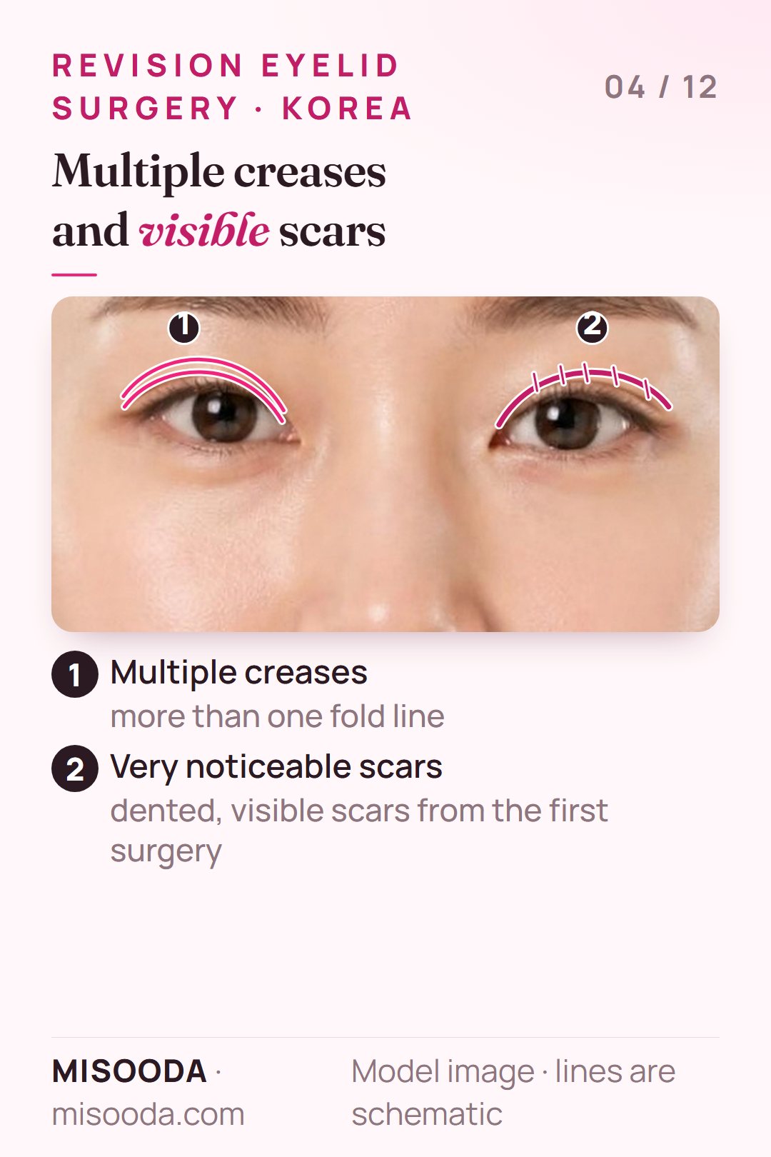 Revision double eyelid cases: multiple creases on one eyelid and a dented, visible scar along the crease on the other, shown schematically on both eyes