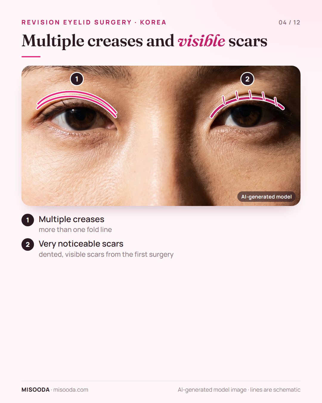 Revision double eyelid cases: multiple creases on one eyelid and a dented, visible scar along the crease on the other, shown schematically on both eyes
