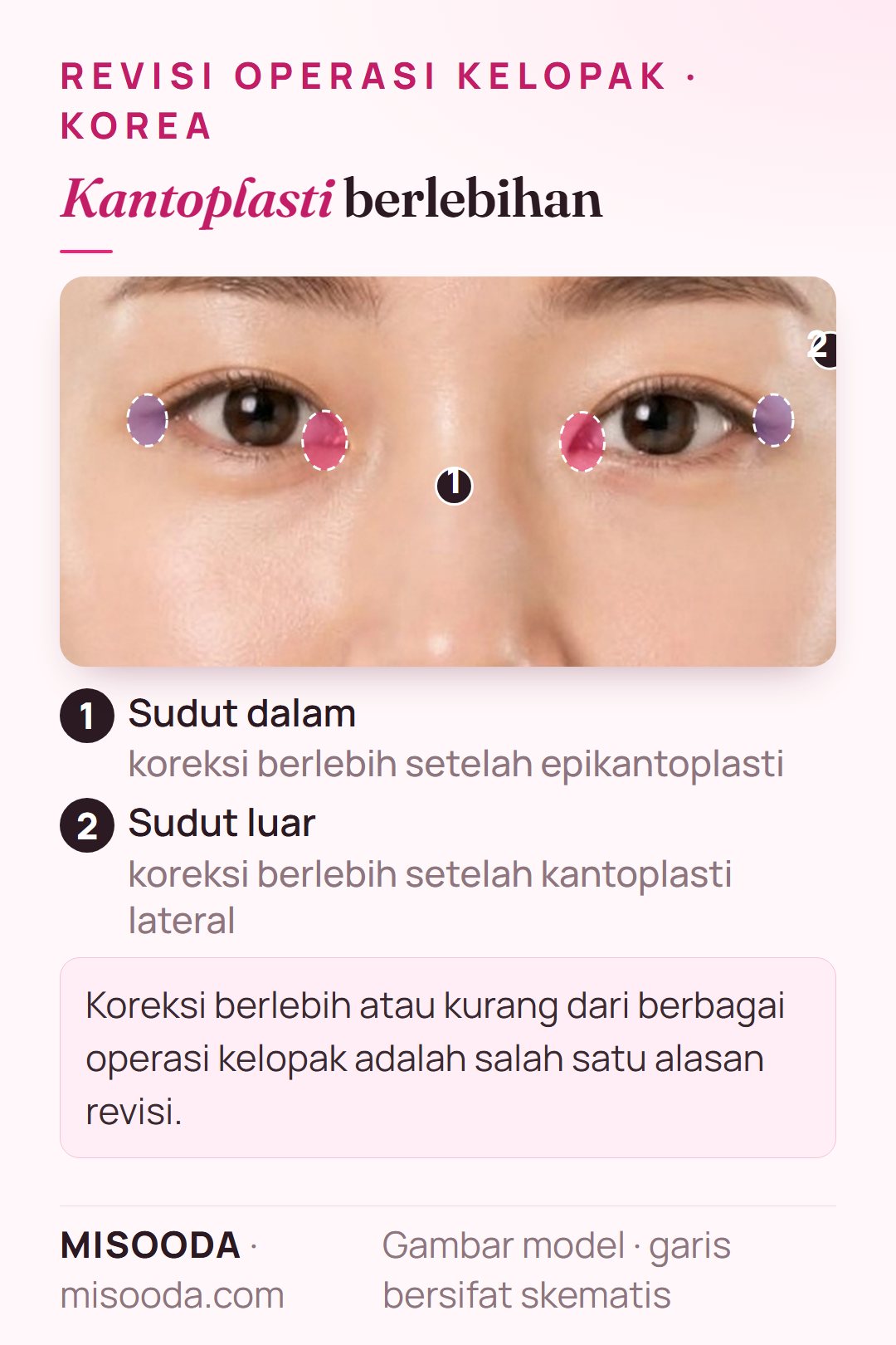 Revisi kantoplasti berlebihan: area sudut dalam (epikantoplasti) dan sudut luar (kantoplasti lateral) ditandai pada kedua mata