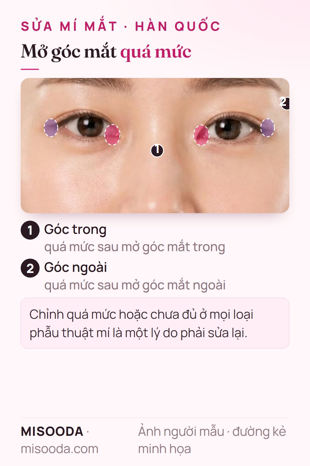 Sửa mở góc mắt quá mức: vùng góc trong (mở góc mắt trong) và góc ngoài (mở góc mắt ngoài) được đánh dấu trên hai mắt