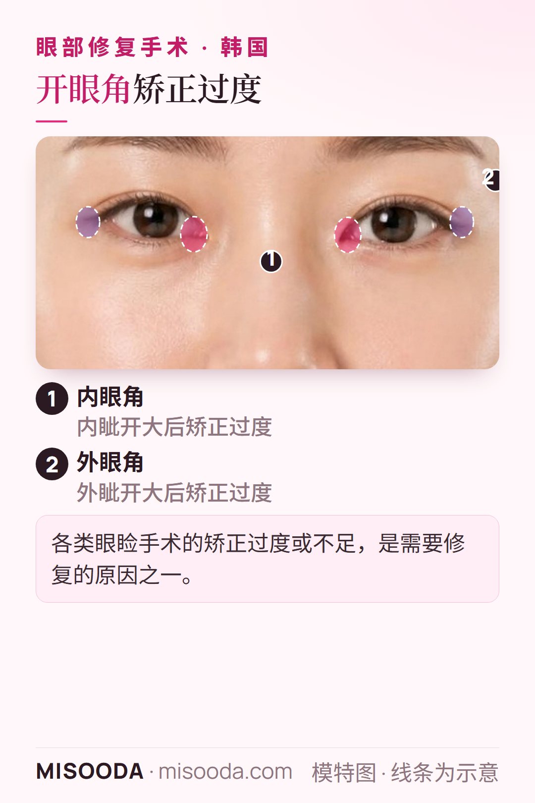 韩国 开眼角矫正过度修复:在双眼上标示内眼角(内眦开大)与外眼角(外眦开大)区域