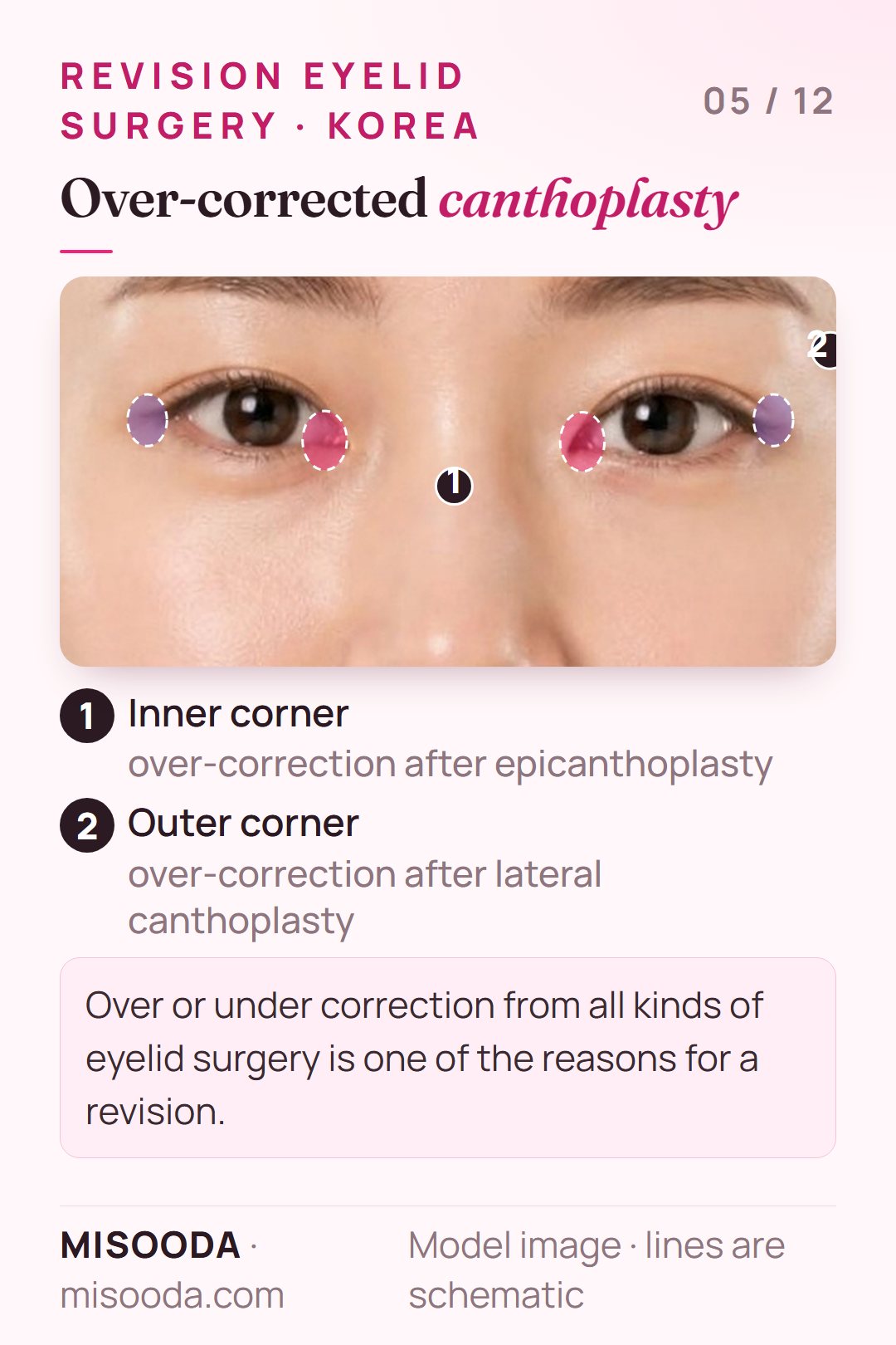 Over-corrected canthoplasty revision: inner corner (epicanthoplasty) and outer corner (lateral canthoplasty) areas highlighted on both eyes