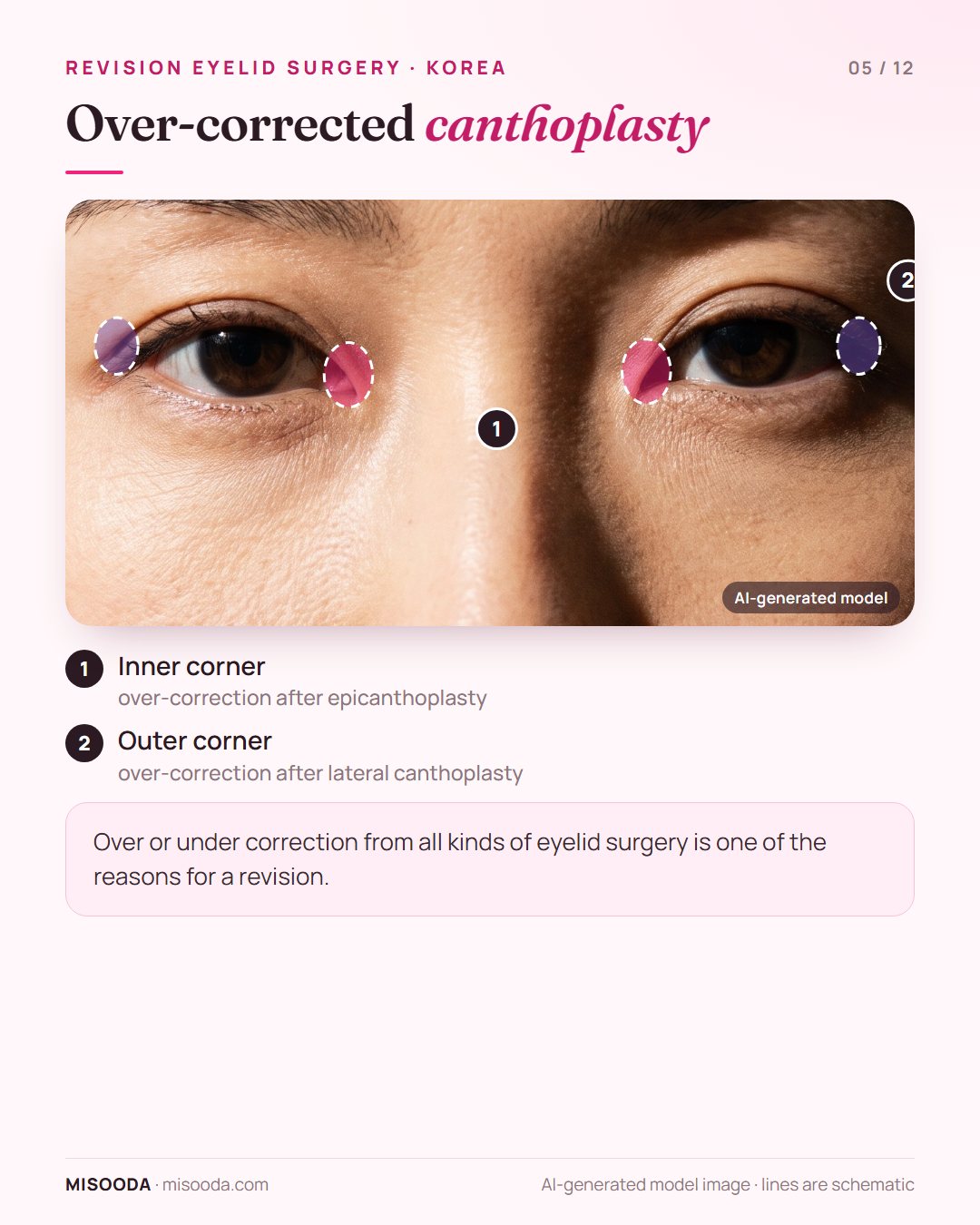 Over-corrected canthoplasty revision: inner corner (epicanthoplasty) and outer corner (lateral canthoplasty) areas highlighted on both eyes