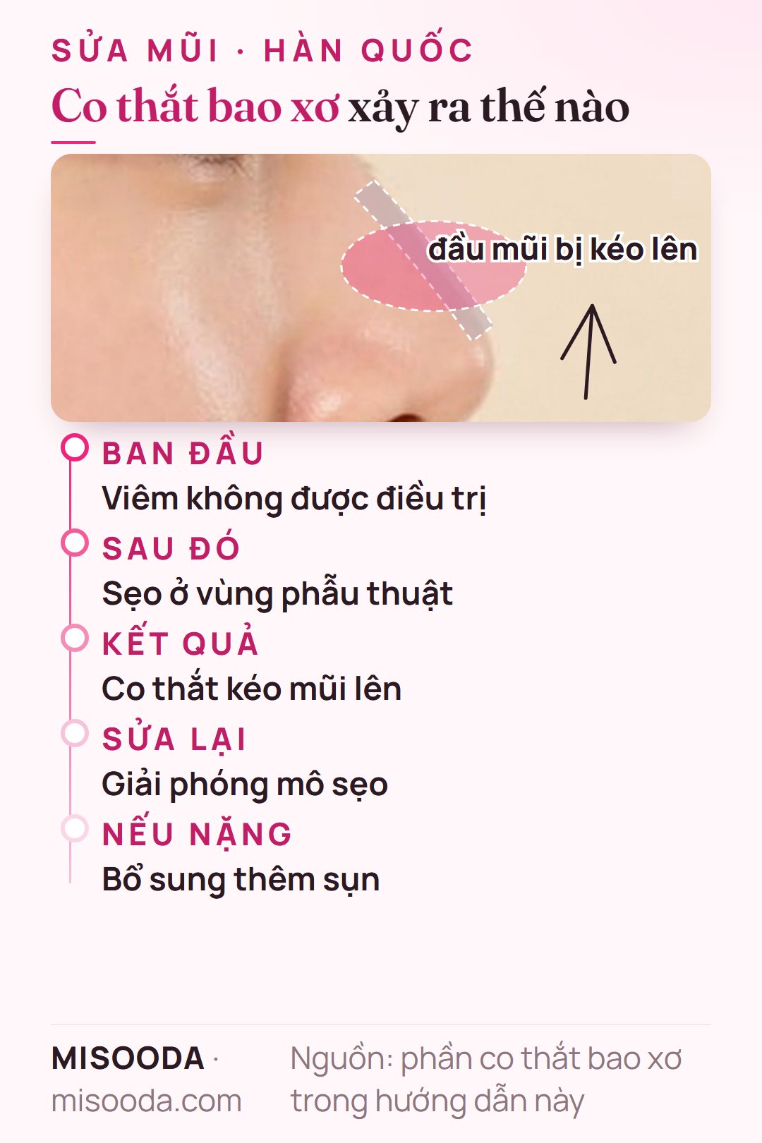 Co thắt bao xơ sau nâng mũi: viêm không điều trị gây sẹo kéo mũi lên; khi sửa sẽ giải phóng mô sẹo và dùng sụn vách ngăn hoặc sụn sườn