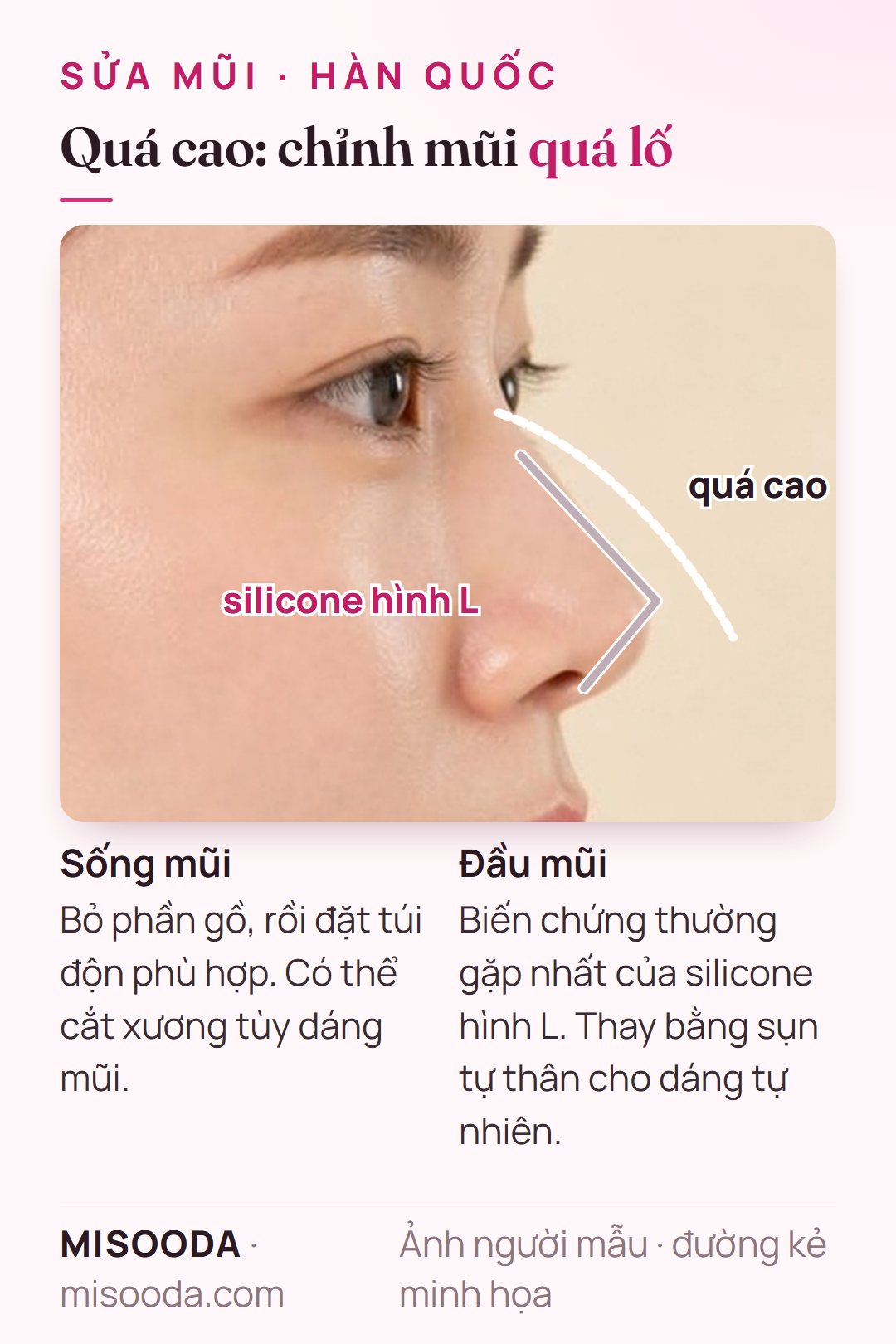Sửa mũi quá lố: sống và đầu mũi quá cao, thay silicone hình L bằng sụn tự thân, bỏ gồ và cắt xương nếu cần