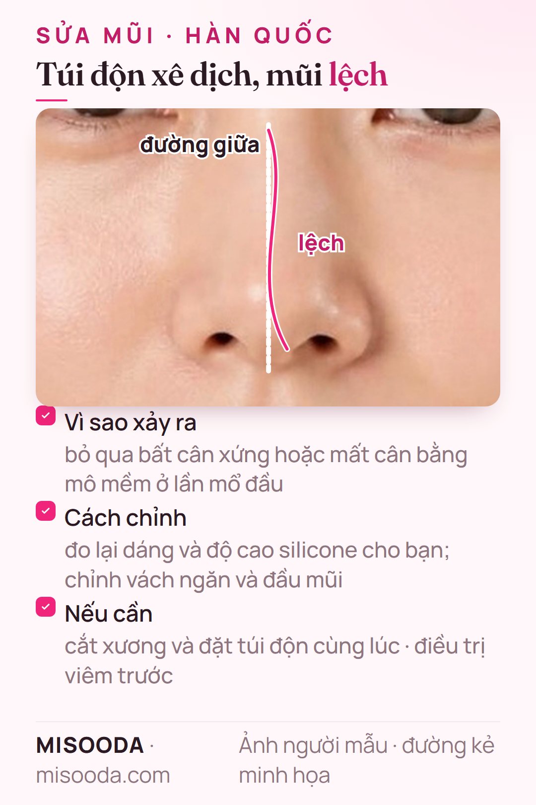Sửa mũi khi túi độn xê dịch hoặc sống mũi lệch: đo lại silicone, chỉnh vách ngăn và đầu mũi, cắt xương thêm nếu cần