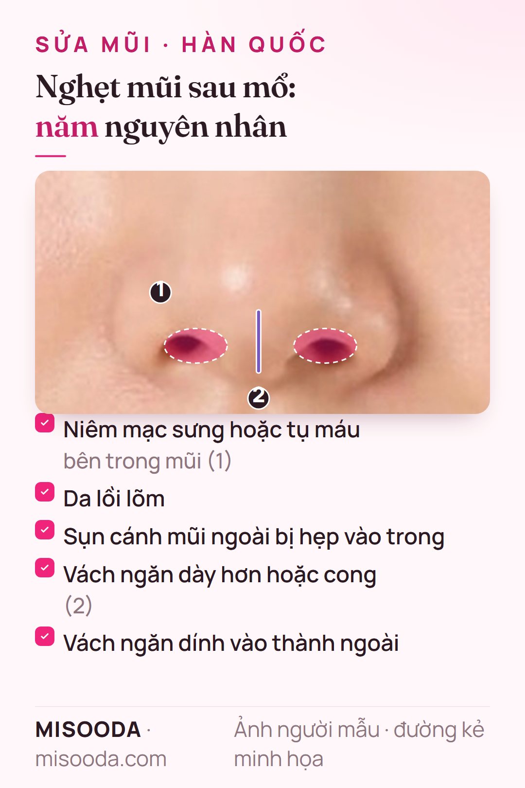 Nguyên nhân nghẹt mũi sau nâng mũi: niêm mạc sưng hoặc tụ máu, da lồi lõm, sụn cánh mũi hẹp vào trong, vách ngăn dày hoặc cong, vách ngăn dính thành mũi
