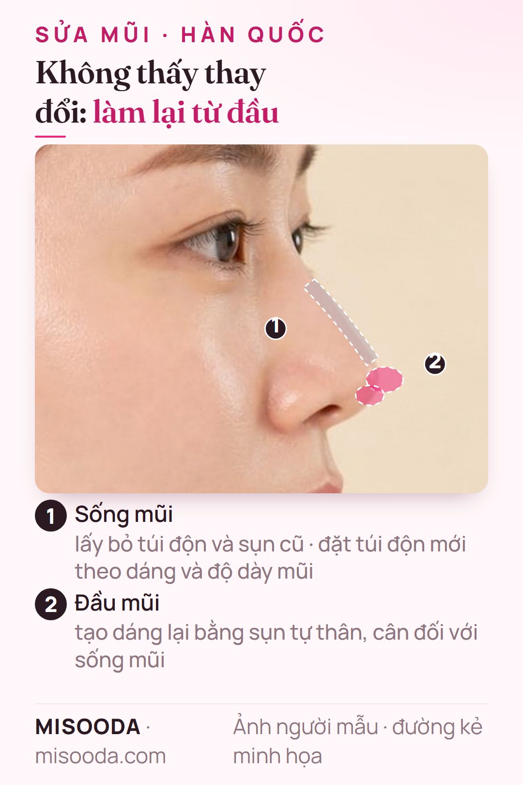 Sửa mũi khi kết quả không ưng ý: lấy bỏ túi độn và sụn cũ, đặt túi độn sống mũi mới và tạo dáng lại đầu mũi bằng sụn tự thân
