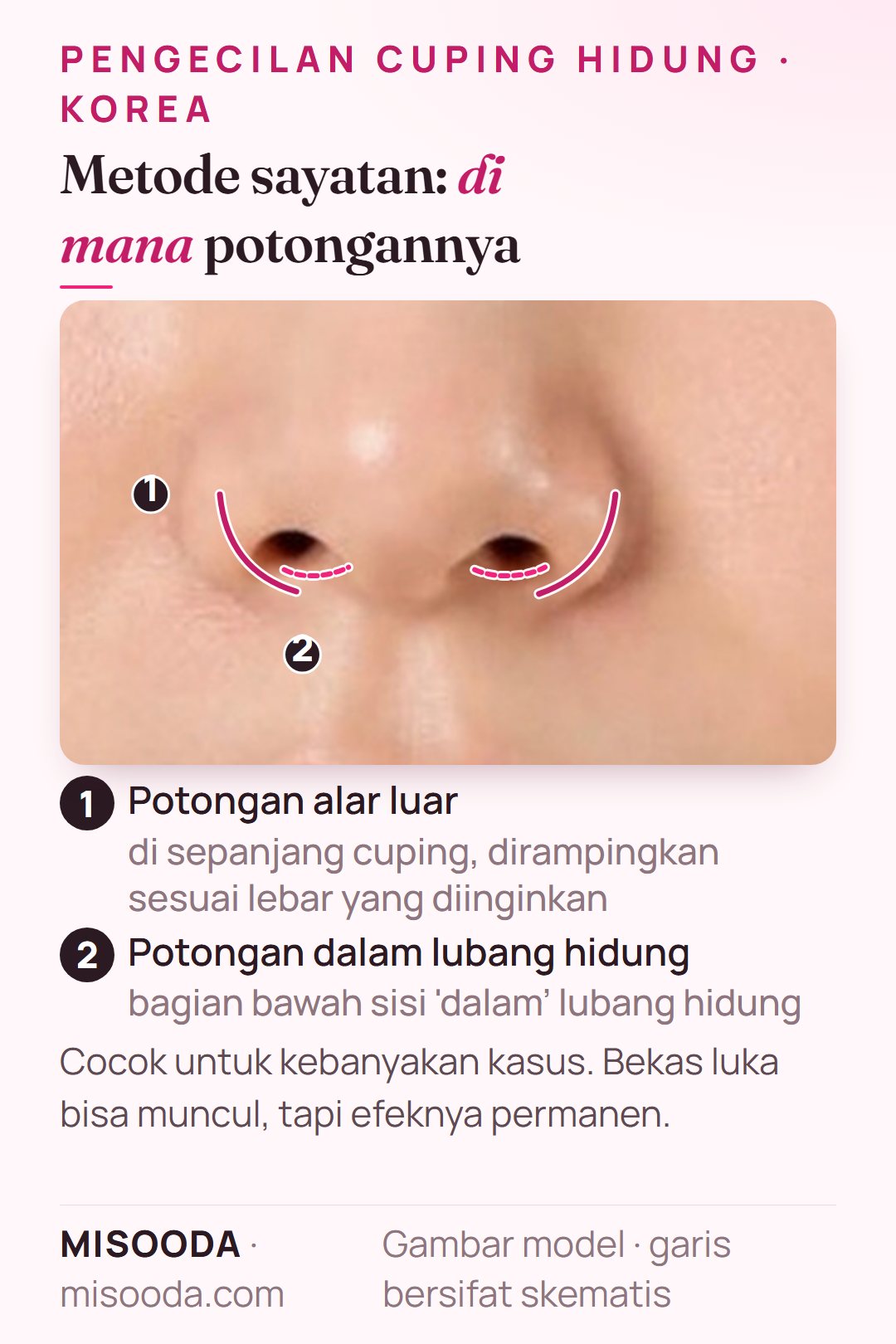 Metode sayatan pengecilan cuping hidung di Korea: potongan di sepanjang cuping luar dan di sisi dalam bawah lubang hidung, merampingkan ala secara permanen