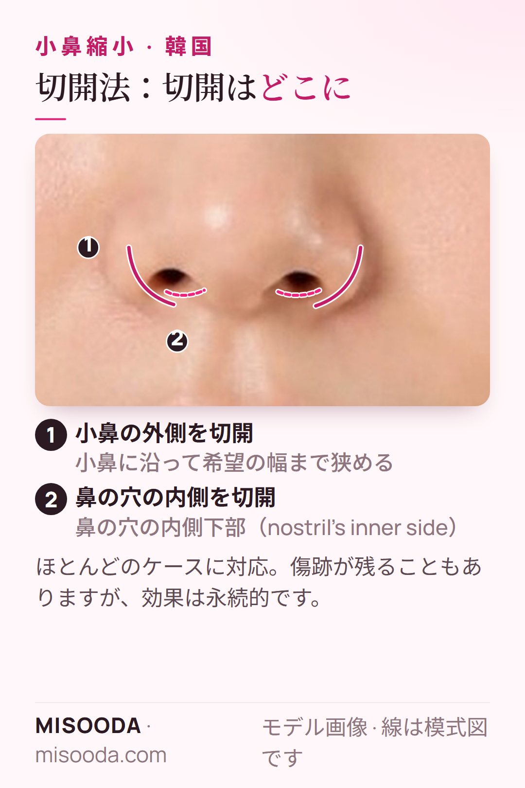 小鼻縮小の切開法:小鼻の外側に沿った切開と鼻の穴の内側下部の切開で、小鼻を永続的に狭くする — 韓国 小鼻縮小