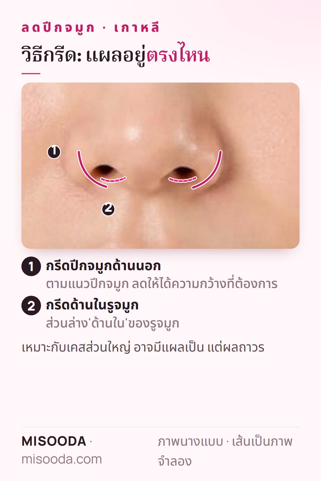 ลดปีกจมูก เกาหลี แบบกรีด: กรีดตามปีกจมูกด้านนอกและด้านในส่วนล่างของรูจมูก ทำให้ปีกจมูกแคบลงอย่างถาวร