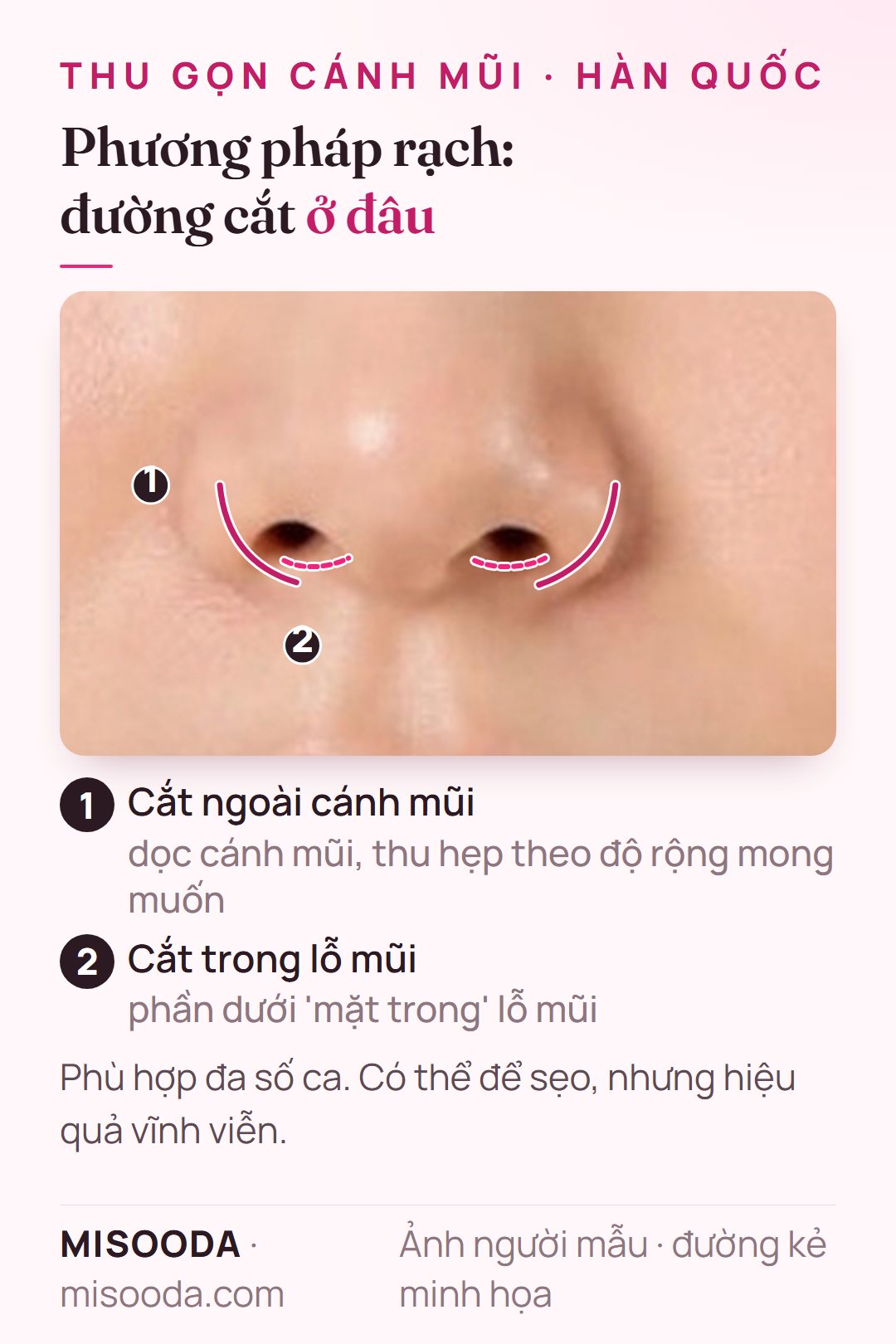 Phương pháp rạch thu gọn cánh mũi: cắt dọc ngoài cánh mũi và ở phần dưới mặt trong lỗ mũi, thu hẹp cánh mũi vĩnh viễn