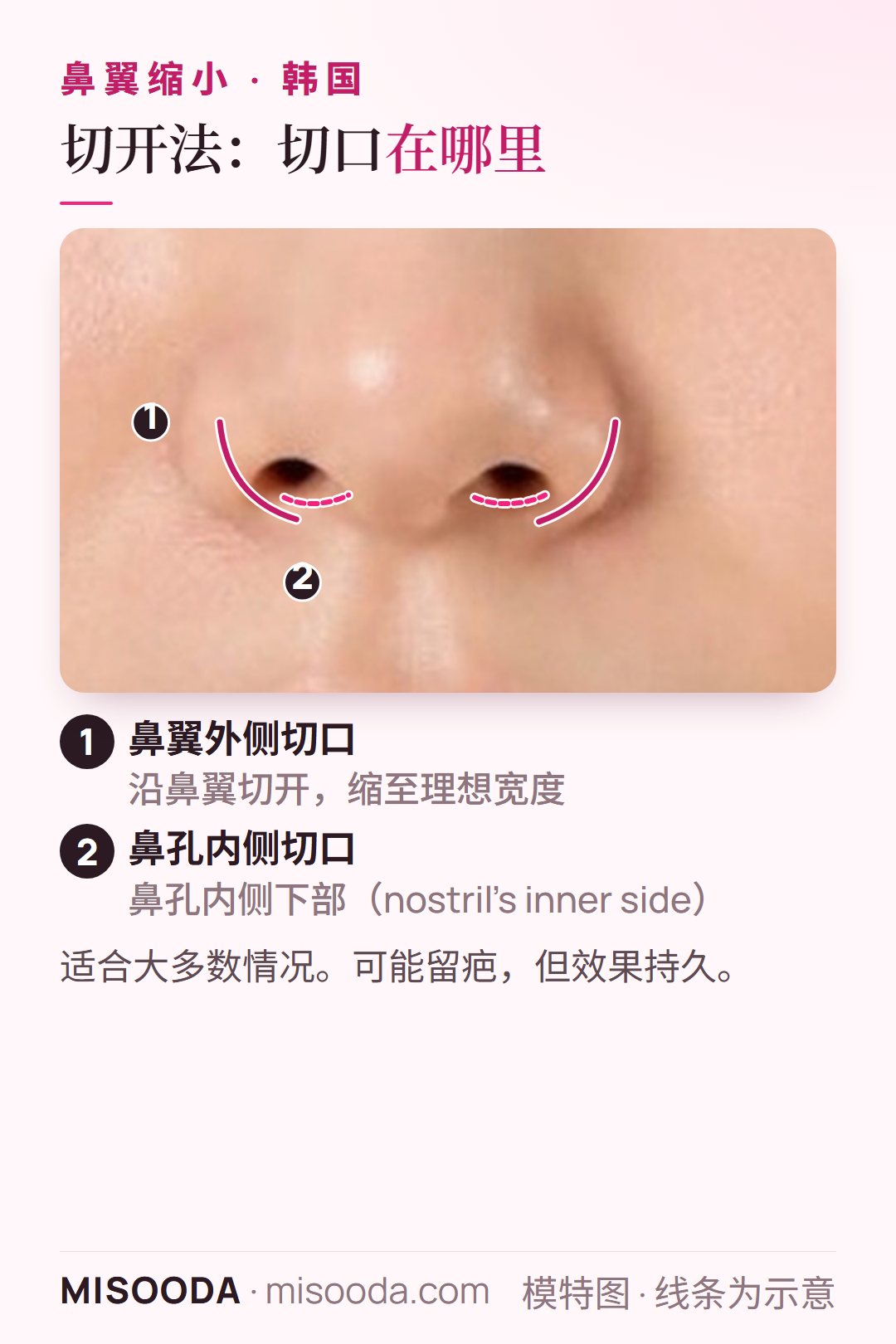韩国 鼻翼缩小切开法示意:沿鼻翼外侧切开,并在鼻孔内侧下部切开,按理想宽度持久缩窄鼻翼,适合大多数情况