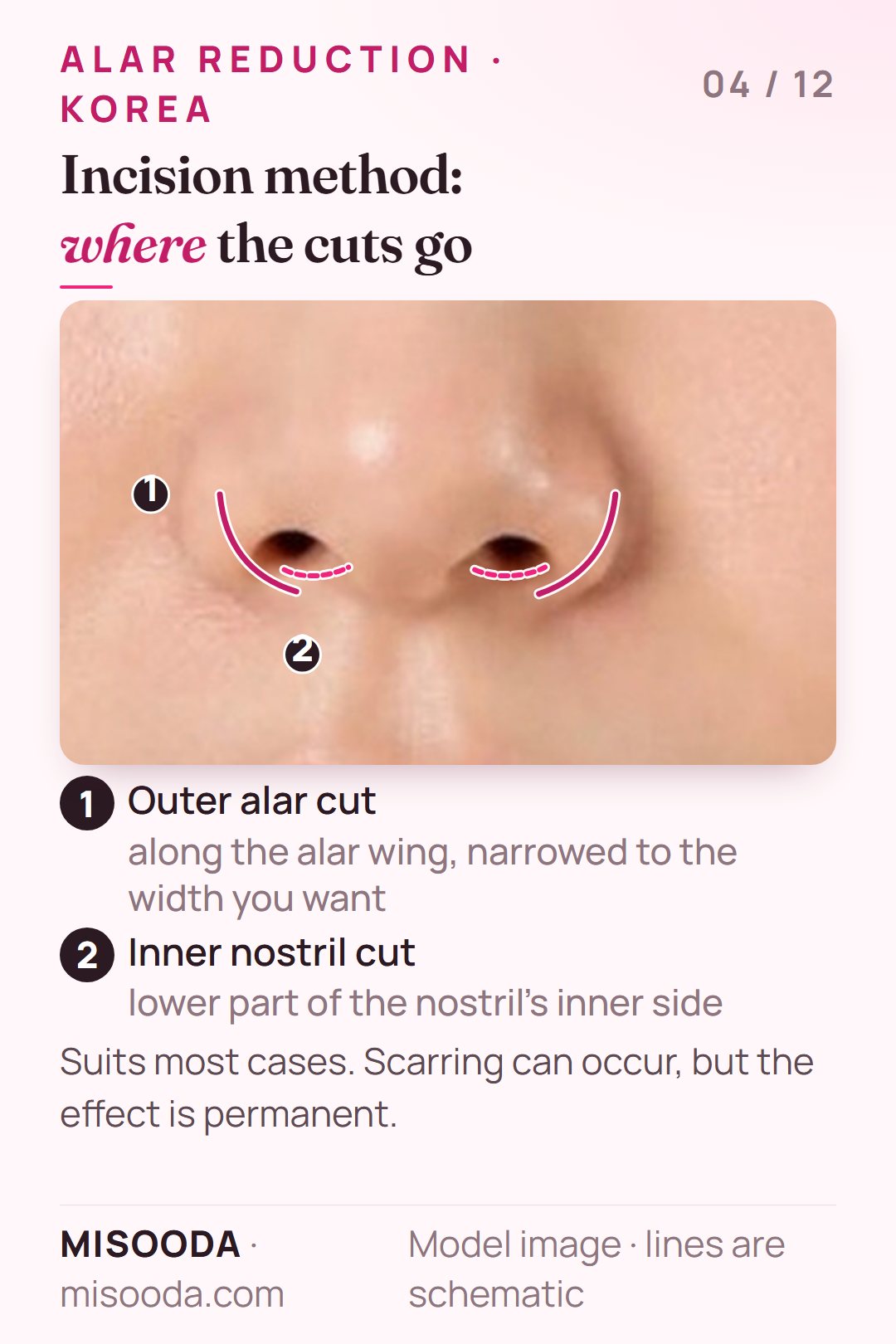 Alar reduction incision method: a cut along the outer alar wing and at the lower inner side of the nostril, narrowing the ala permanently