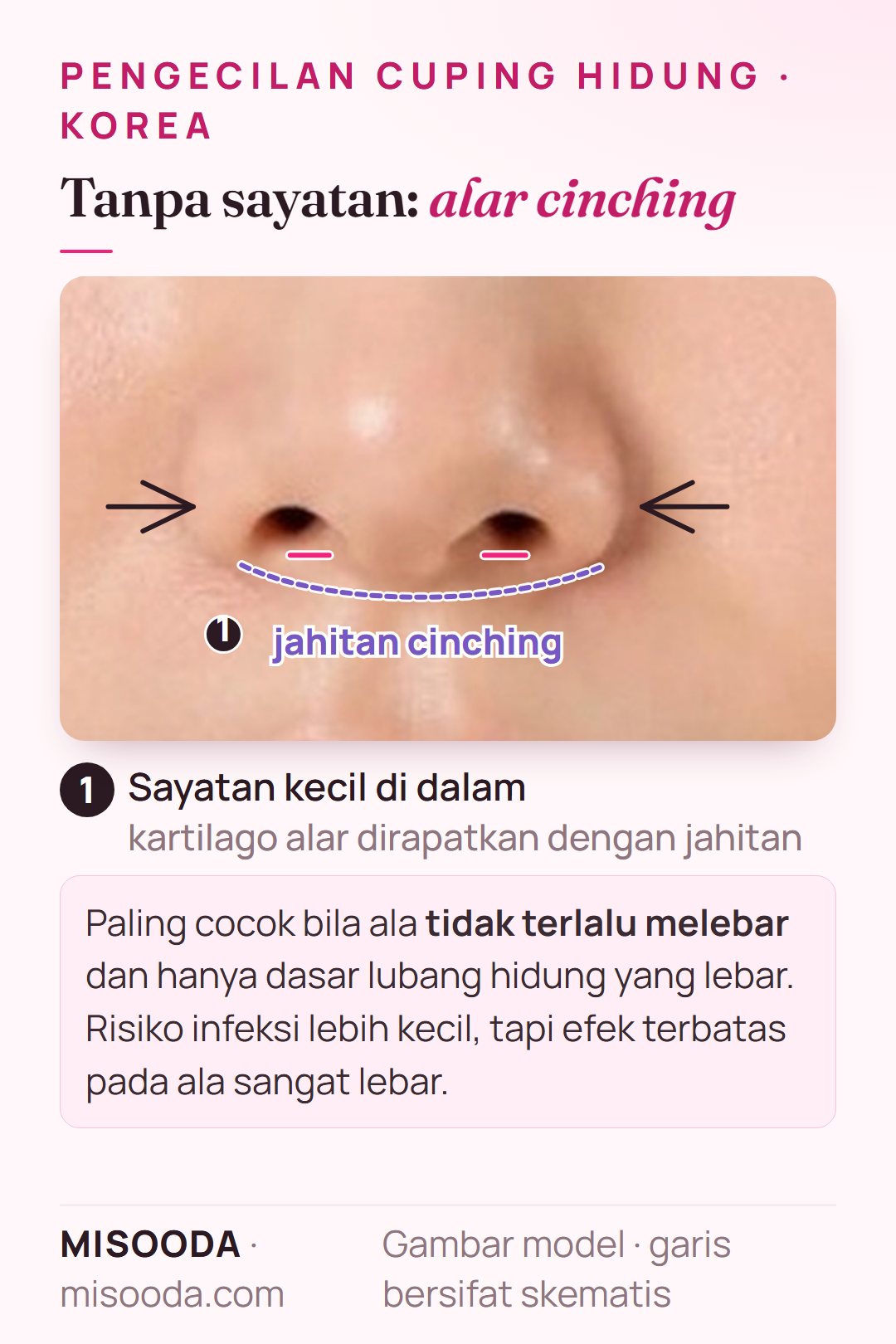 Pengecilan cuping hidung tanpa sayatan dengan alar cinching: sayatan kecil di dalam dan jahitan yang merapatkan kartilago alar untuk dasar lubang hidung yang agak lebar