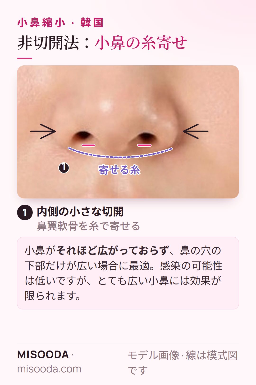 糸寄せによる非切開の小鼻縮小:内側の小さな切開から鼻翼軟骨を糸で寄せ、少し広い鼻の穴の下部を狭くする — 韓国 小鼻縮小