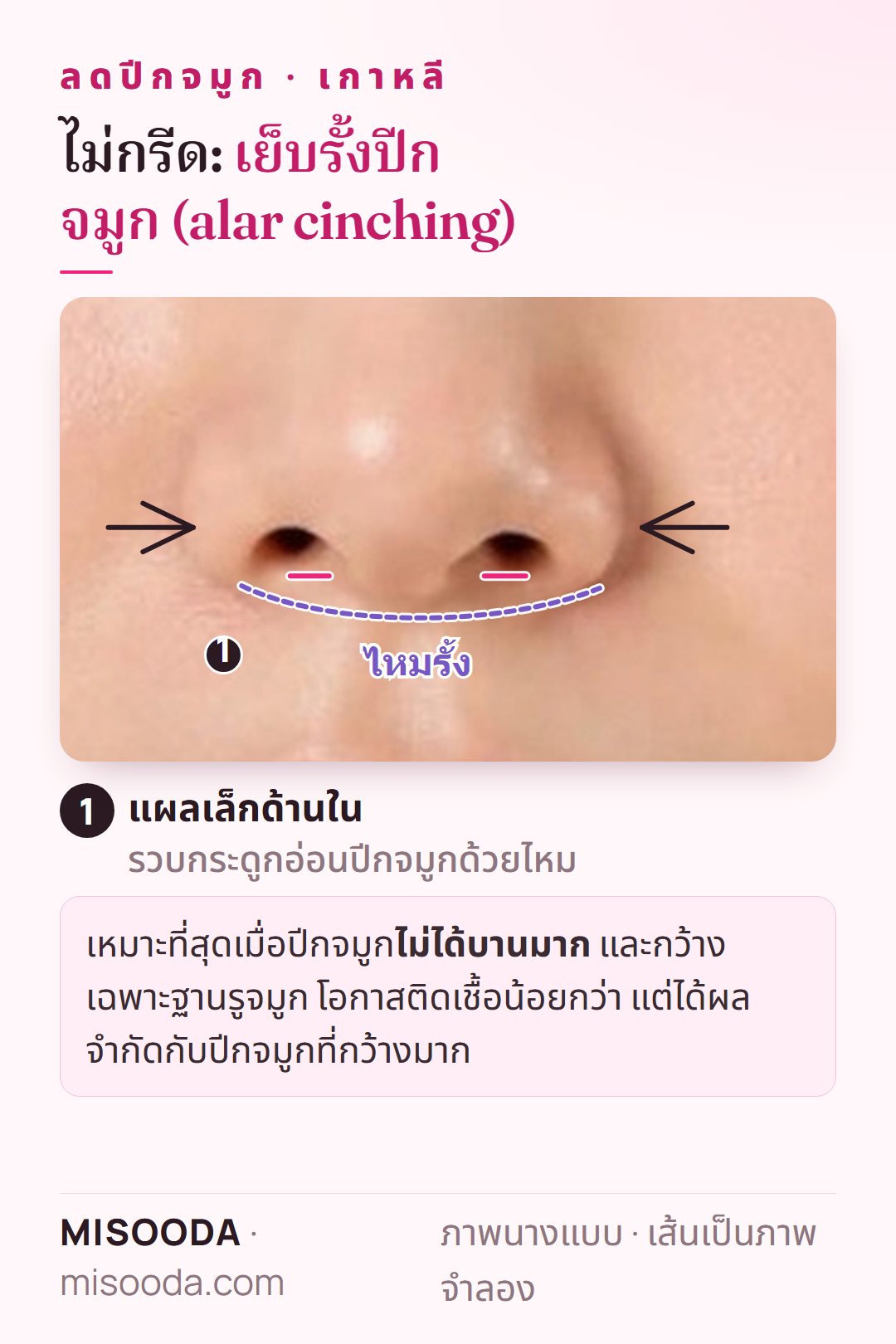 ลดปีกจมูก เกาหลี แบบไม่กรีดด้วยการเย็บรั้ง: แผลเล็กด้านในและไหมที่รวบกระดูกอ่อนปีกจมูกเพื่อลดฐานรูจมูกที่กว้างเล็กน้อย