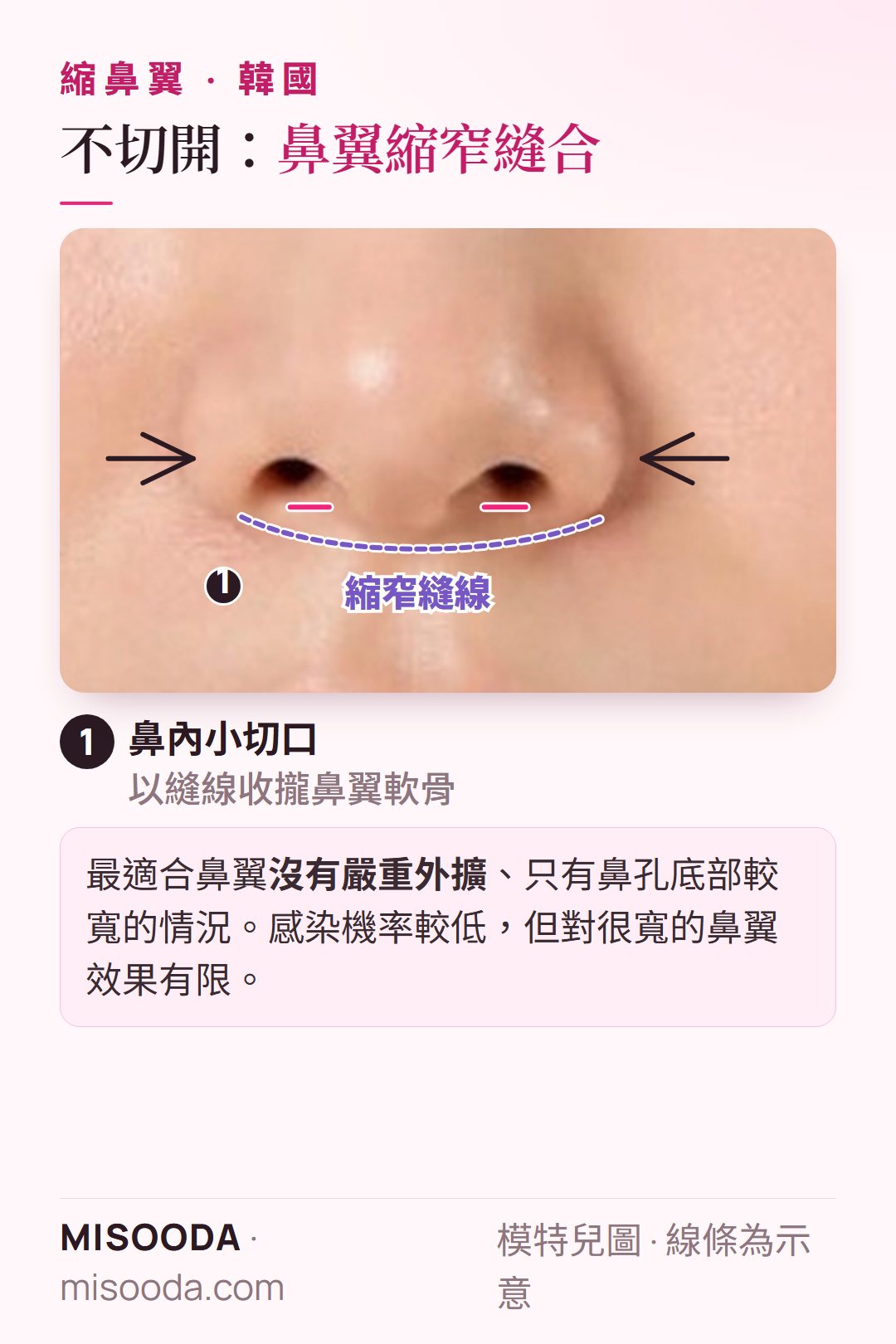 韓國 不切開縮鼻翼(鼻翼縮窄縫合):鼻內小切口,以縫線收攏鼻翼軟骨,縮窄輕度偏寬的鼻孔底部