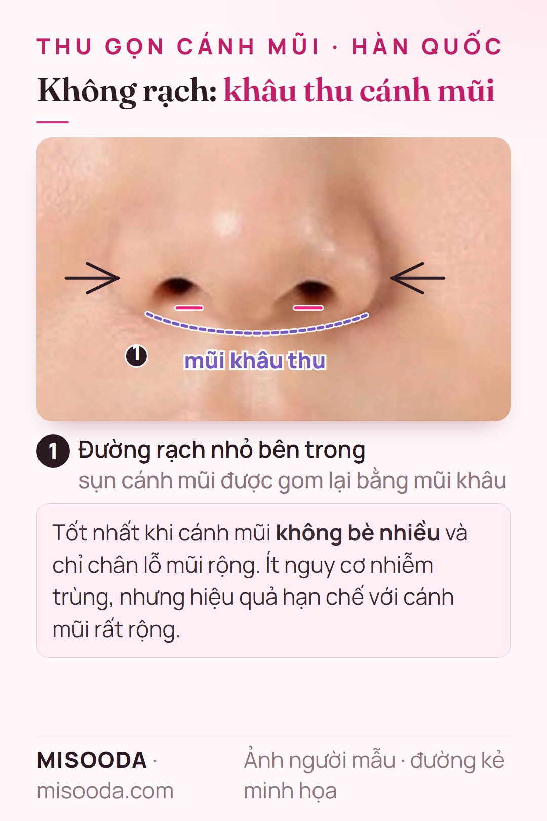 Thu gọn cánh mũi không rạch bằng khâu thu: đường rạch nhỏ bên trong và mũi khâu gom sụn cánh mũi để thu hẹp chân lỗ mũi hơi rộng