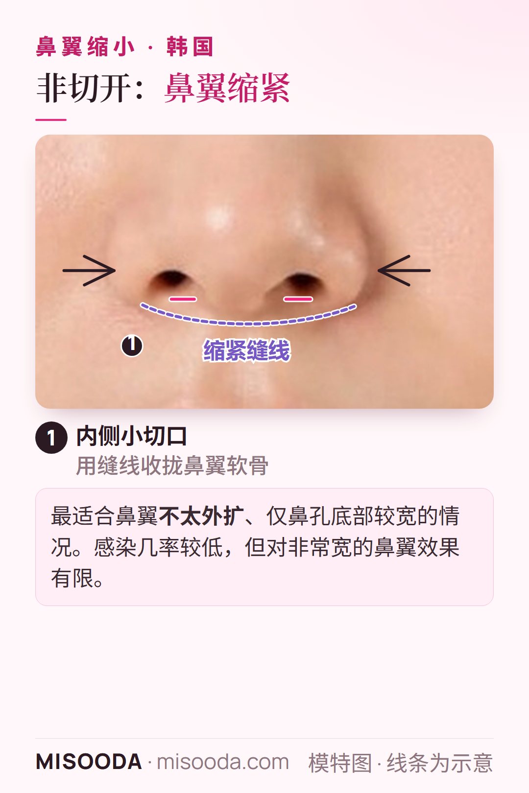 韩国 非切开鼻翼缩小(鼻翼缩紧):内侧小切口加缝线收拢鼻翼软骨,缩窄轻度偏宽的鼻孔底部