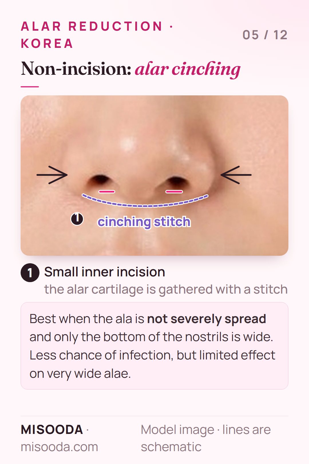 Non-incision alar reduction by alar cinching: a small inner incision and a stitch that gathers the alar cartilage to narrow a mildly wide nostril base