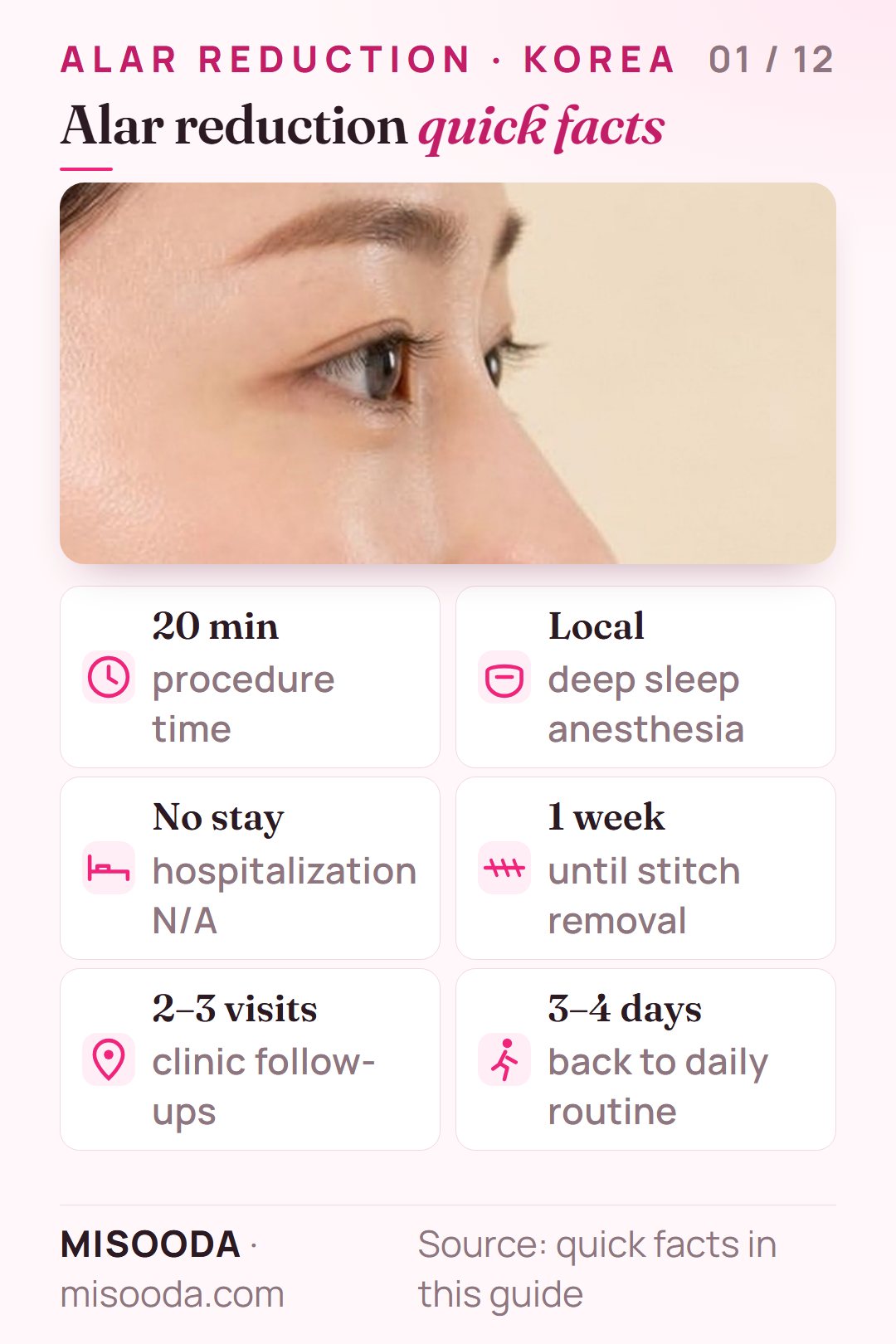 Alar reduction quick facts: about 20 minutes under local deep-sleep anesthesia, no hospital stay, stitches out after 1 week, 2–3 clinic visits, daily routine after 3–4 days
