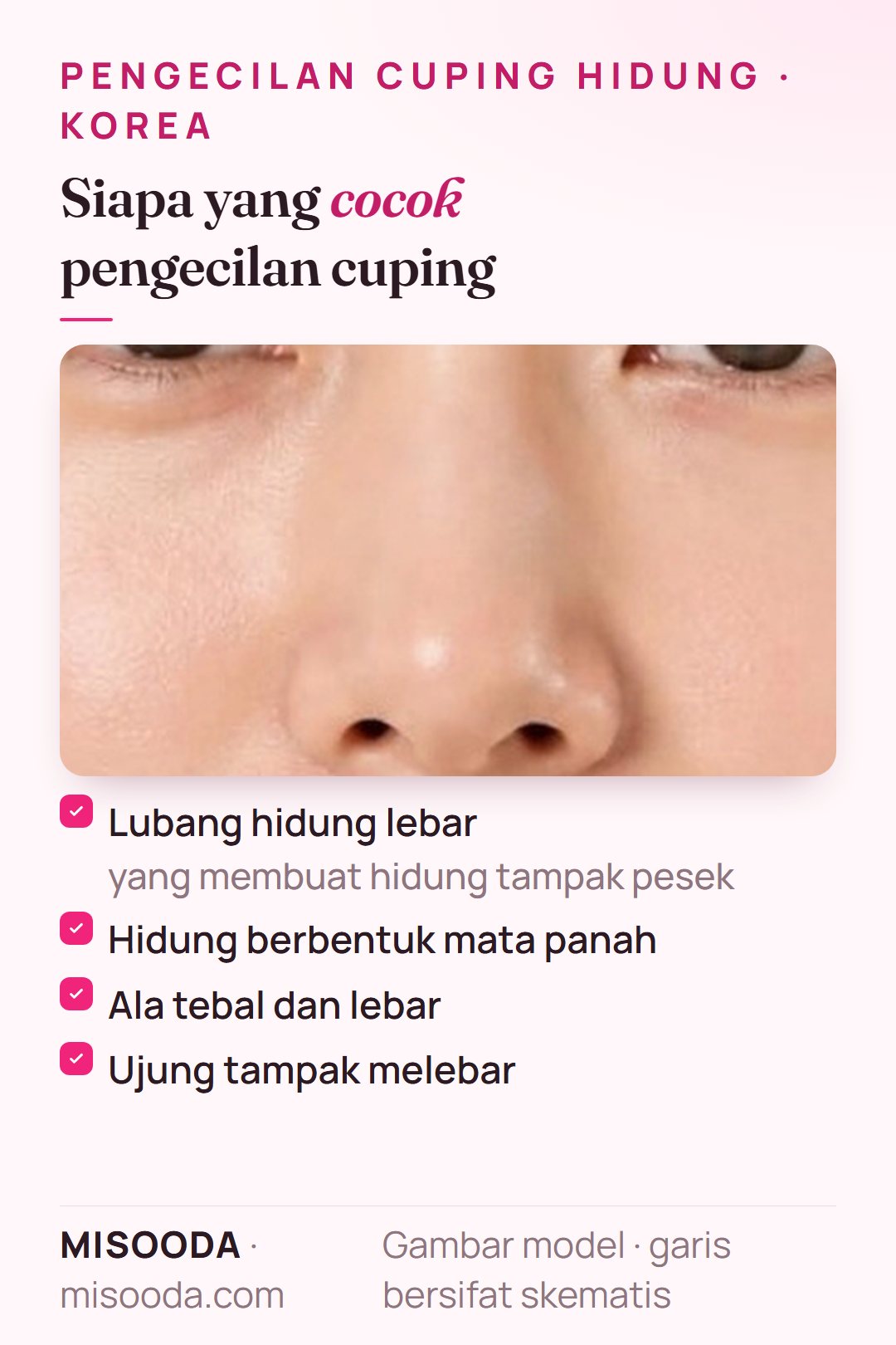 Kandidat pengecilan cuping hidung di Korea: lubang hidung lebar yang membuat hidung tampak pesek, hidung mata panah, ala tebal dan lebar, atau ujung hidung melebar