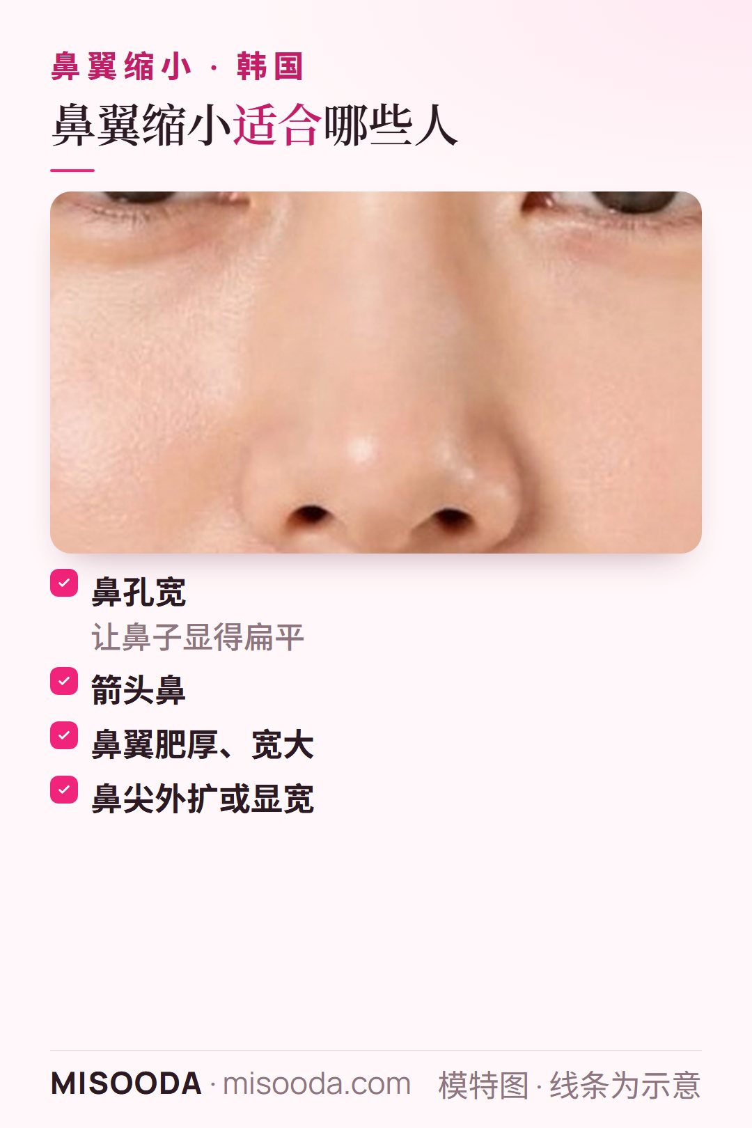 韩国 鼻翼缩小适合人群:鼻孔宽让鼻子显得扁平、箭头鼻、鼻翼肥厚宽大,或鼻尖外扩、看起来偏宽的人
