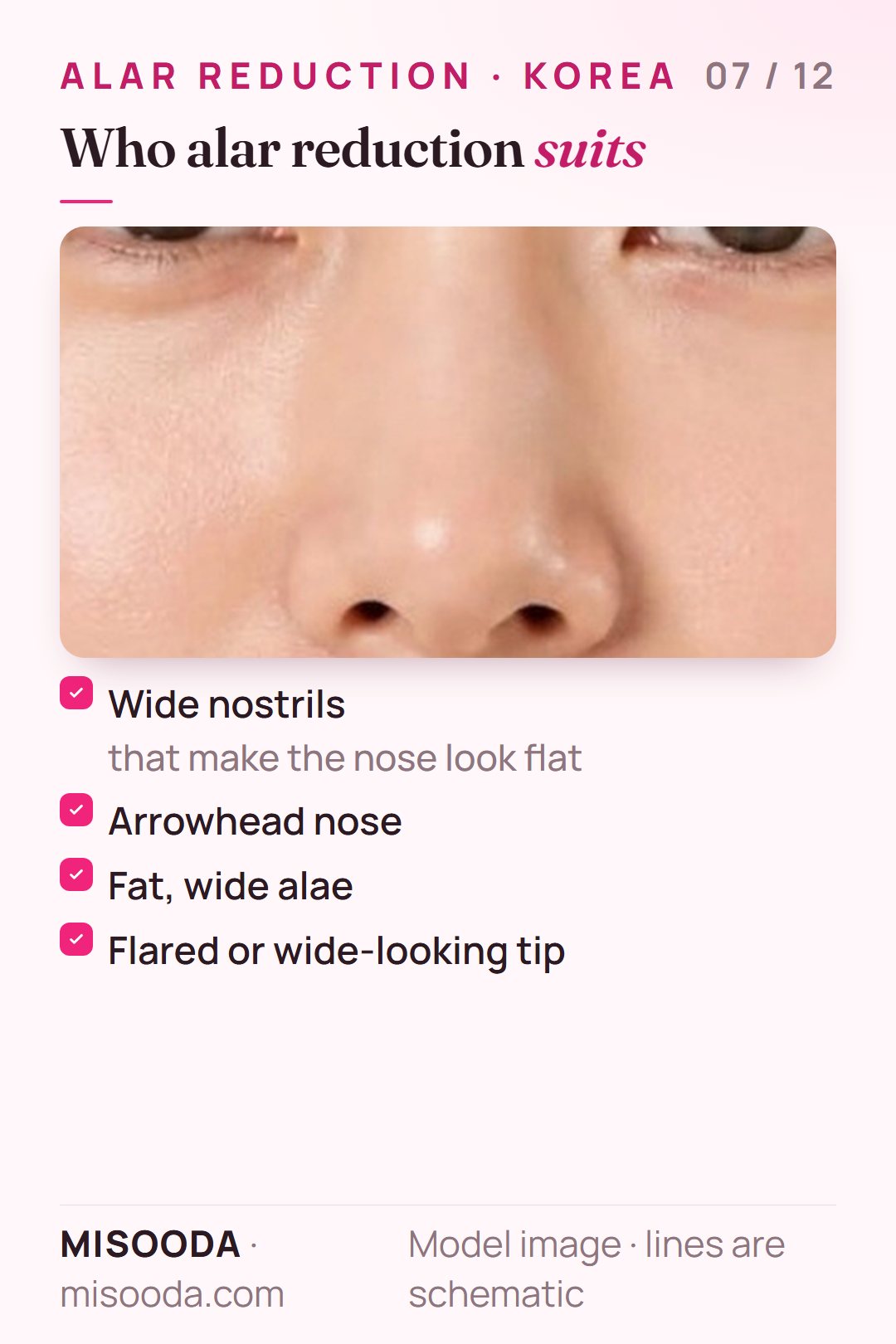 Alar reduction candidates: wide nostrils that make the nose look flat, an arrowhead nose, fat and wide alae, or a flared, wide-looking nose tip