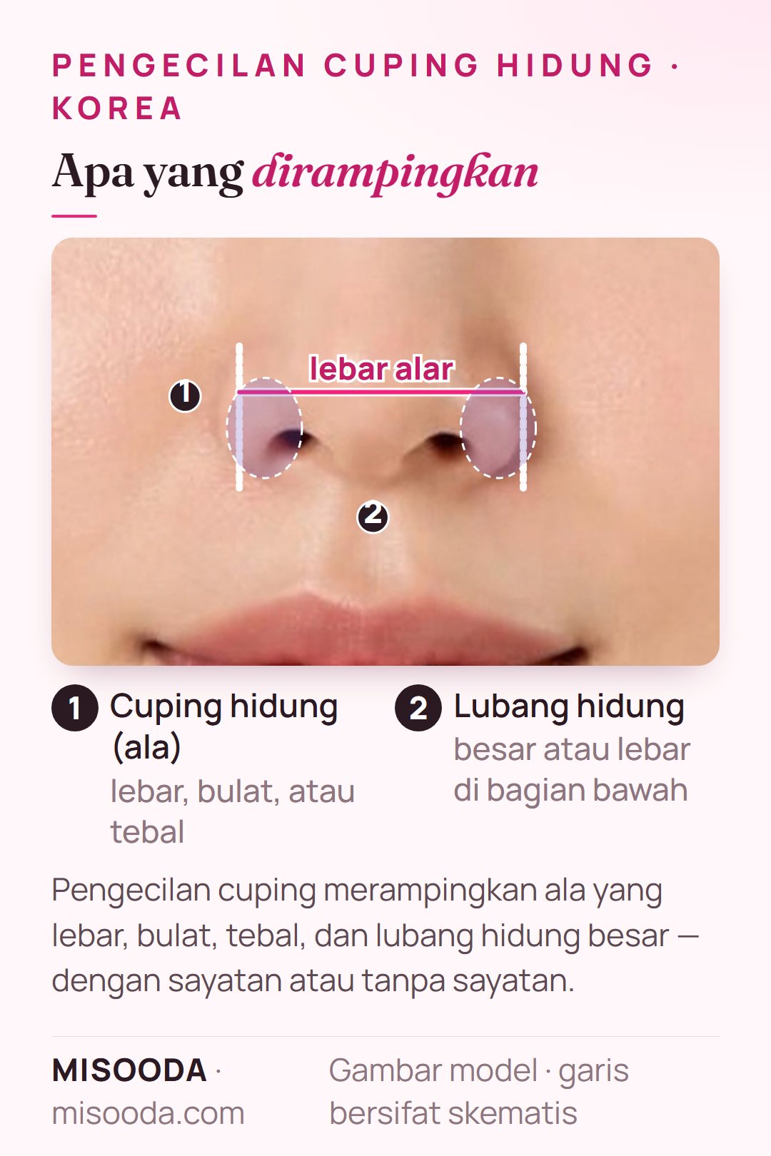 Area sasaran pengecilan cuping hidung pada tampak depan hidung: cuping lebar, bulat, atau tebal dan lubang hidung besar, dengan lebar alar ditandai