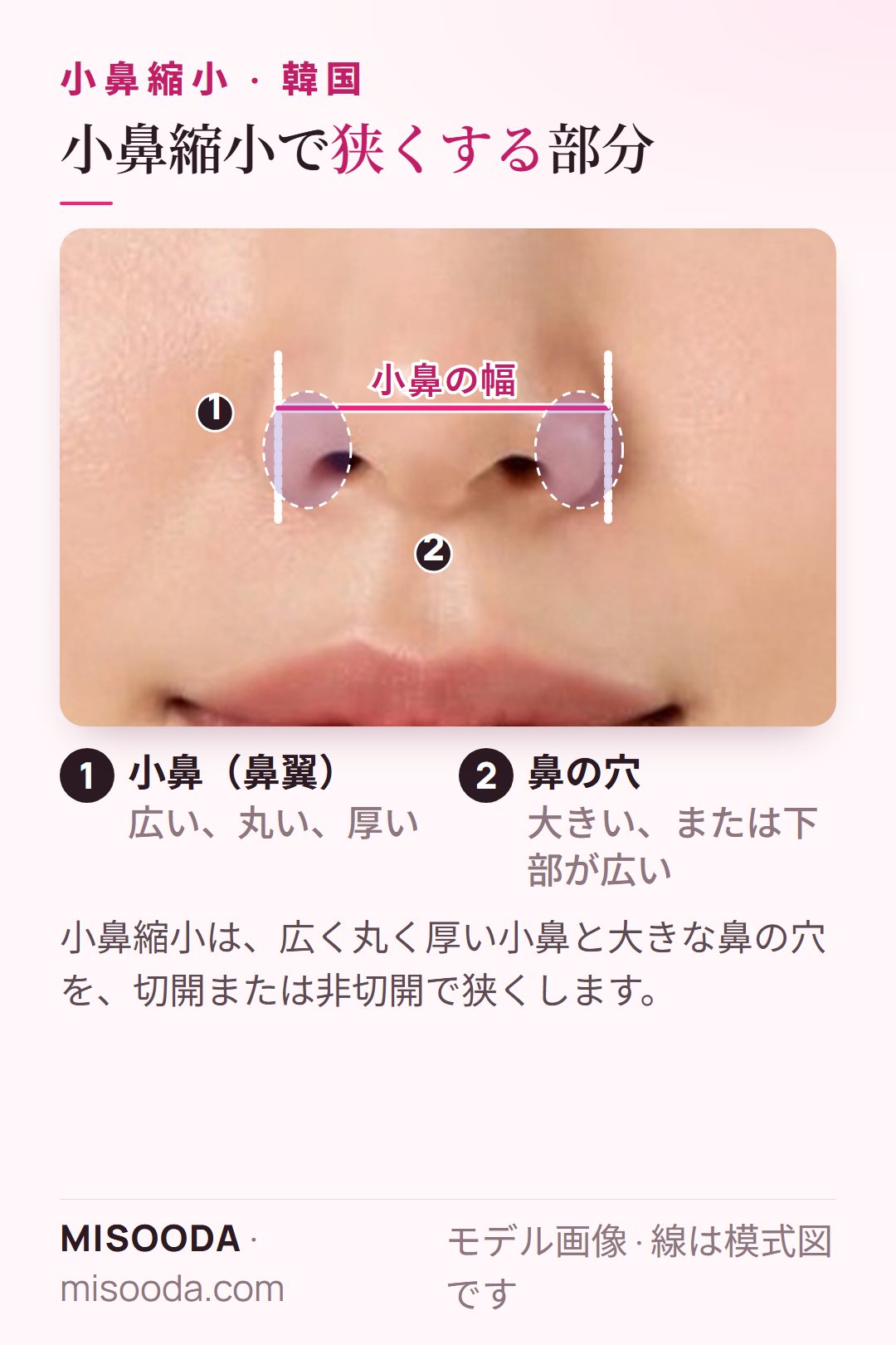 正面から見た小鼻縮小の対象部位:広い・丸い・厚い小鼻と大きな鼻の穴、小鼻の幅を表示 — 韓国 小鼻縮小
