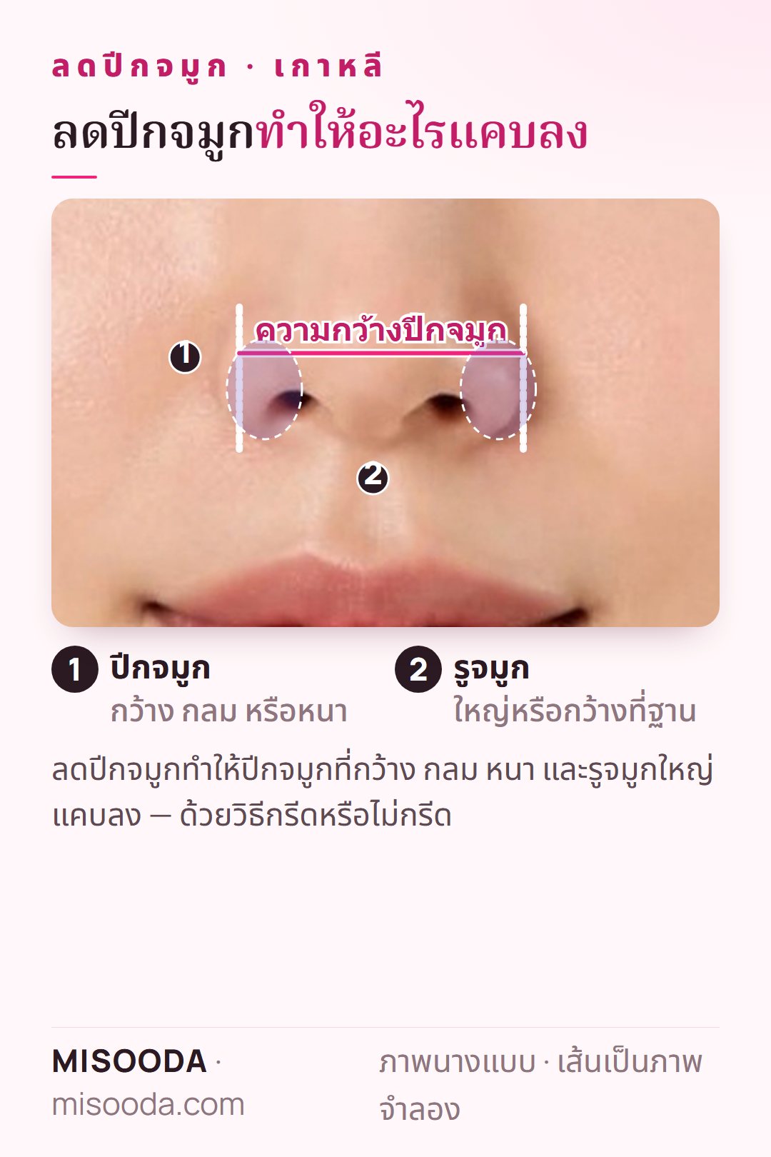 บริเวณเป้าหมายของการลดปีกจมูก เกาหลี ในภาพด้านหน้า: ปีกจมูกกว้าง กลม หรือหนา และรูจมูกใหญ่ พร้อมระบุความกว้างปีกจมูก