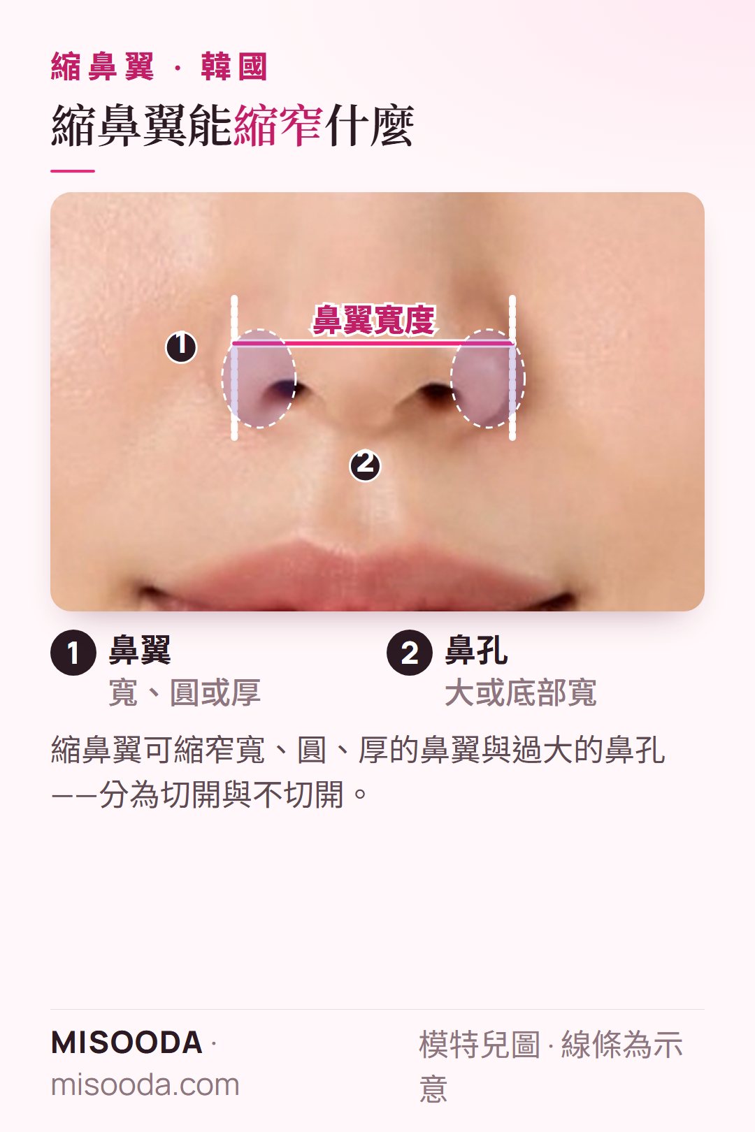 韓國 縮鼻翼要處理的目標部位,以鼻部正面圖呈現:寬、圓或厚的鼻翼與過大的鼻孔,並標示鼻翼寬度
