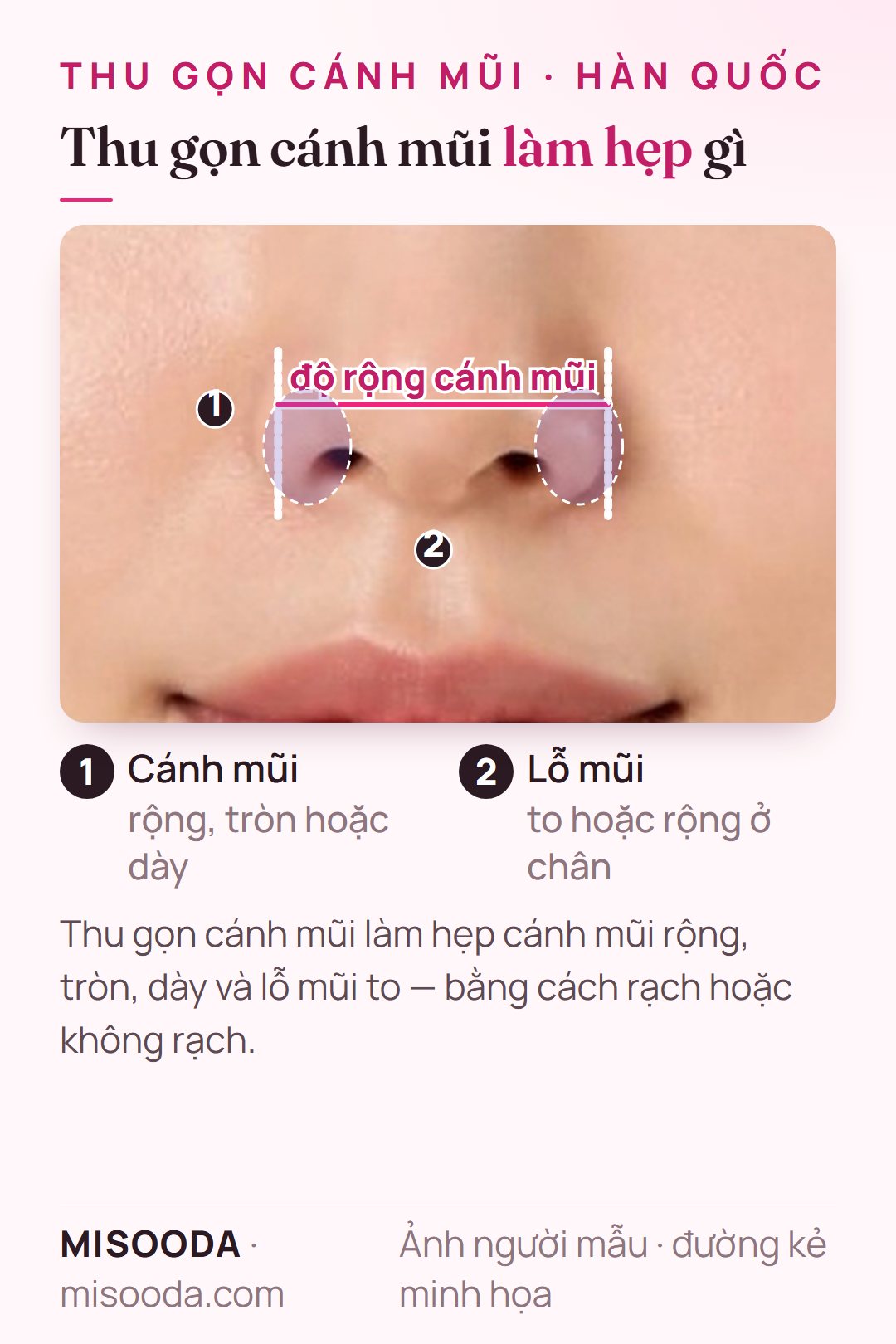 Vùng thu gọn cánh mũi nhìn thẳng: cánh mũi rộng, tròn hoặc dày và lỗ mũi to, có đánh dấu độ rộng cánh mũi