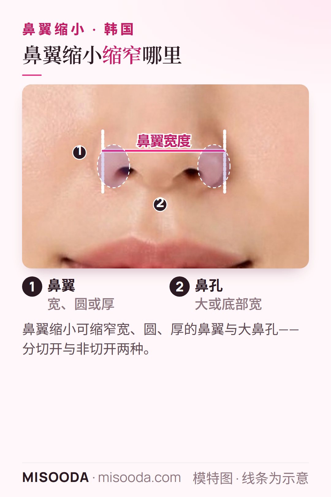 韩国 鼻翼缩小的目标部位(鼻子正面示意):宽、圆或厚的鼻翼与较大的鼻孔,并标示出鼻翼宽度,便于对照自己的鼻型