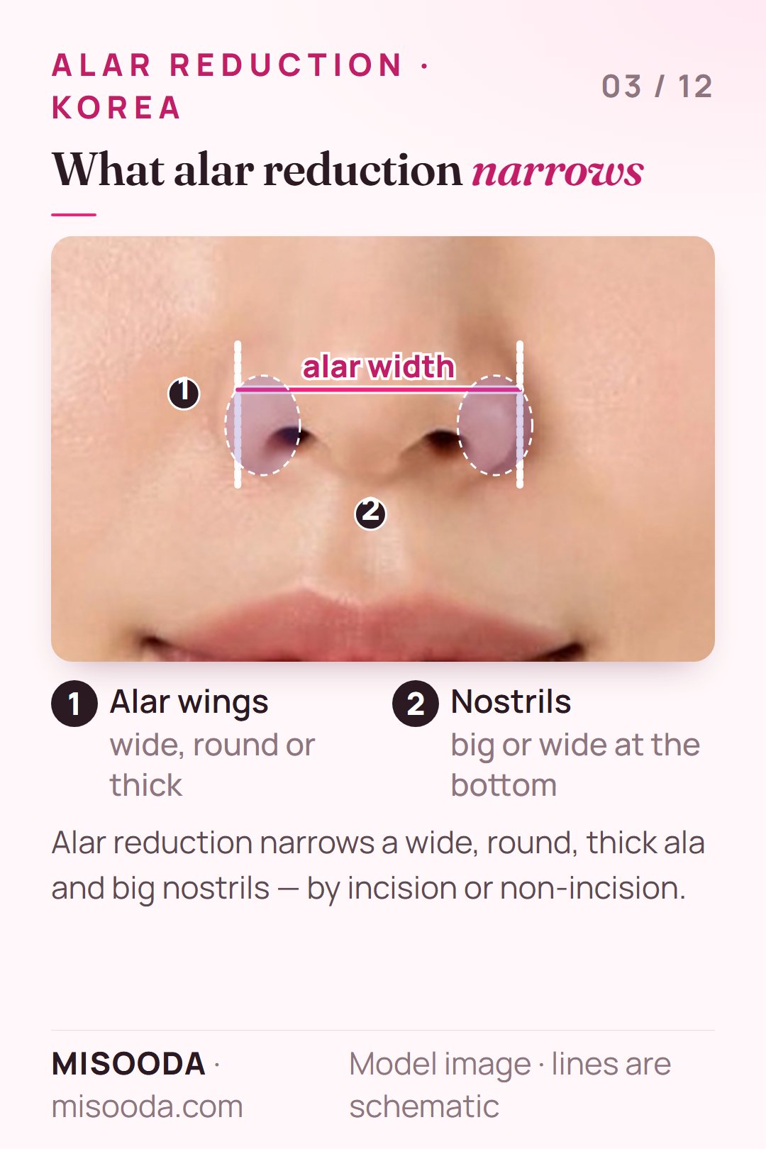 Alar reduction target areas on a front view of the nose: wide, round or thick alar wings and big nostrils, with the alar width marked