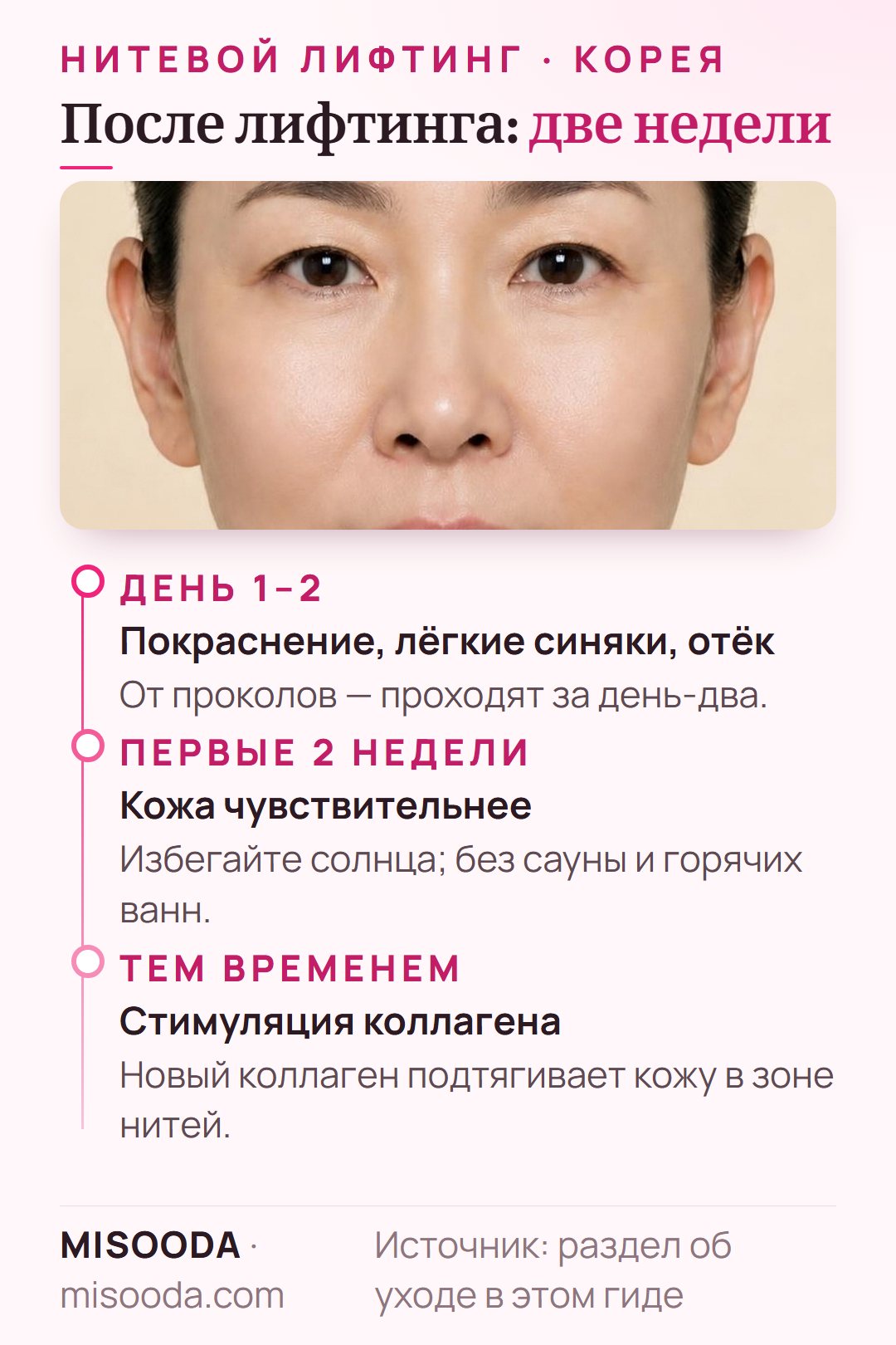 Уход после нитевого лифтинга: покраснение, лёгкие синяки и отёк день-два, затем 2 недели без солнца, сауны и горячих ванн
