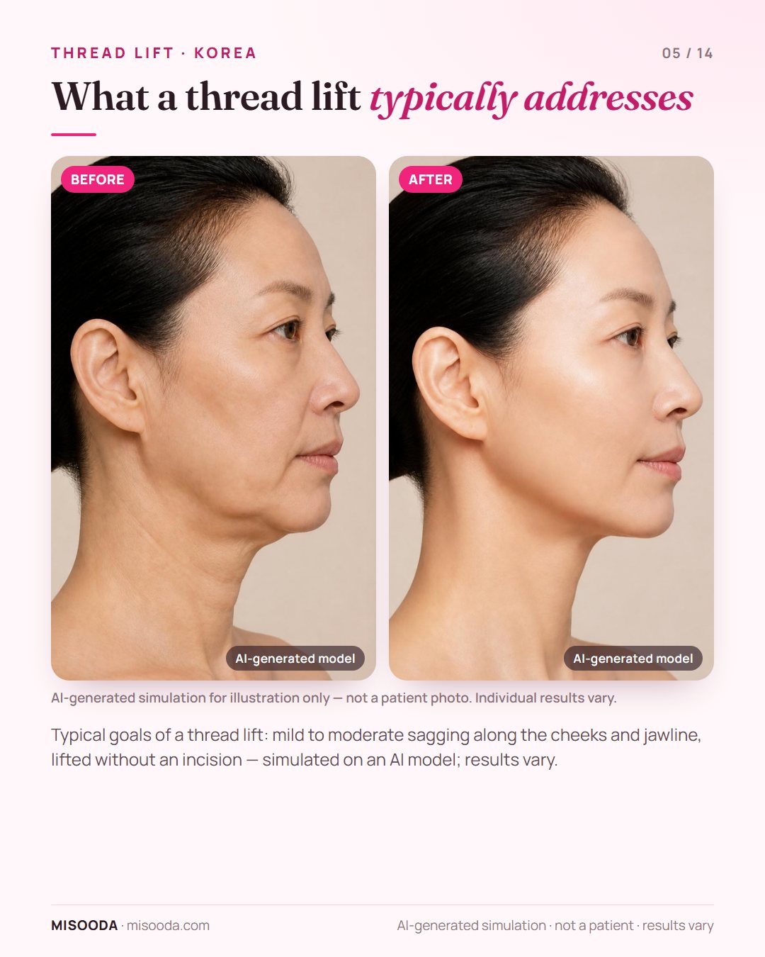Illustration of the typical goals of a thread lift in Korea — mild to moderate sagging along the cheeks and jawline — simulated on an AI model, not a patient