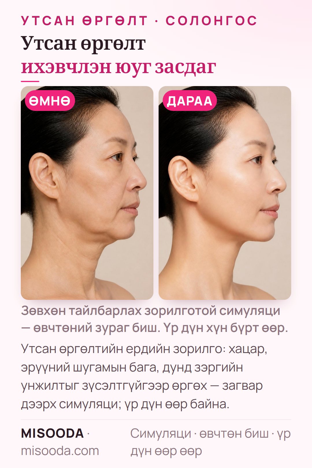 Солонгост хийх утсан өргөлтийн ердийн зорилгын зураг — хацар, эрүүний шугамын бага зэргээс дунд зэргийн суларалт — загвар дээрх симуляци, өвчтөн биш
