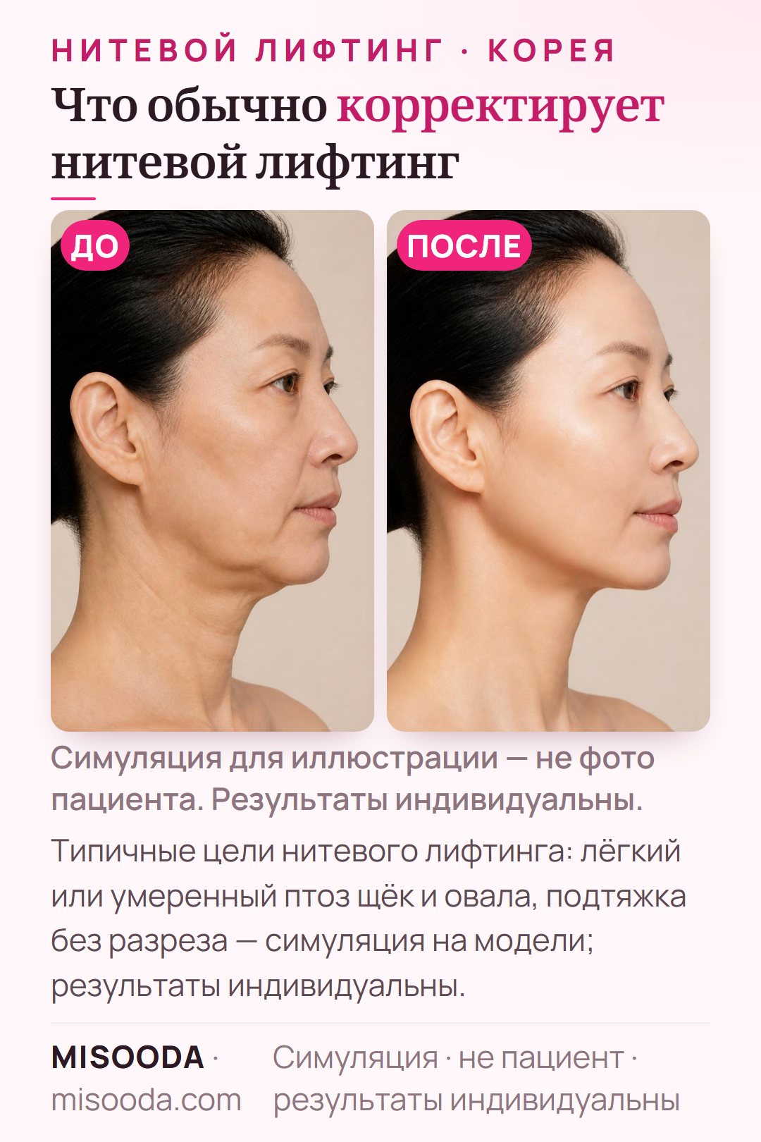 Иллюстрация типичных целей нитевого лифтинга в Корее — лёгкий или умеренный птоз щёк и овала лица — симуляция на модели, не пациент