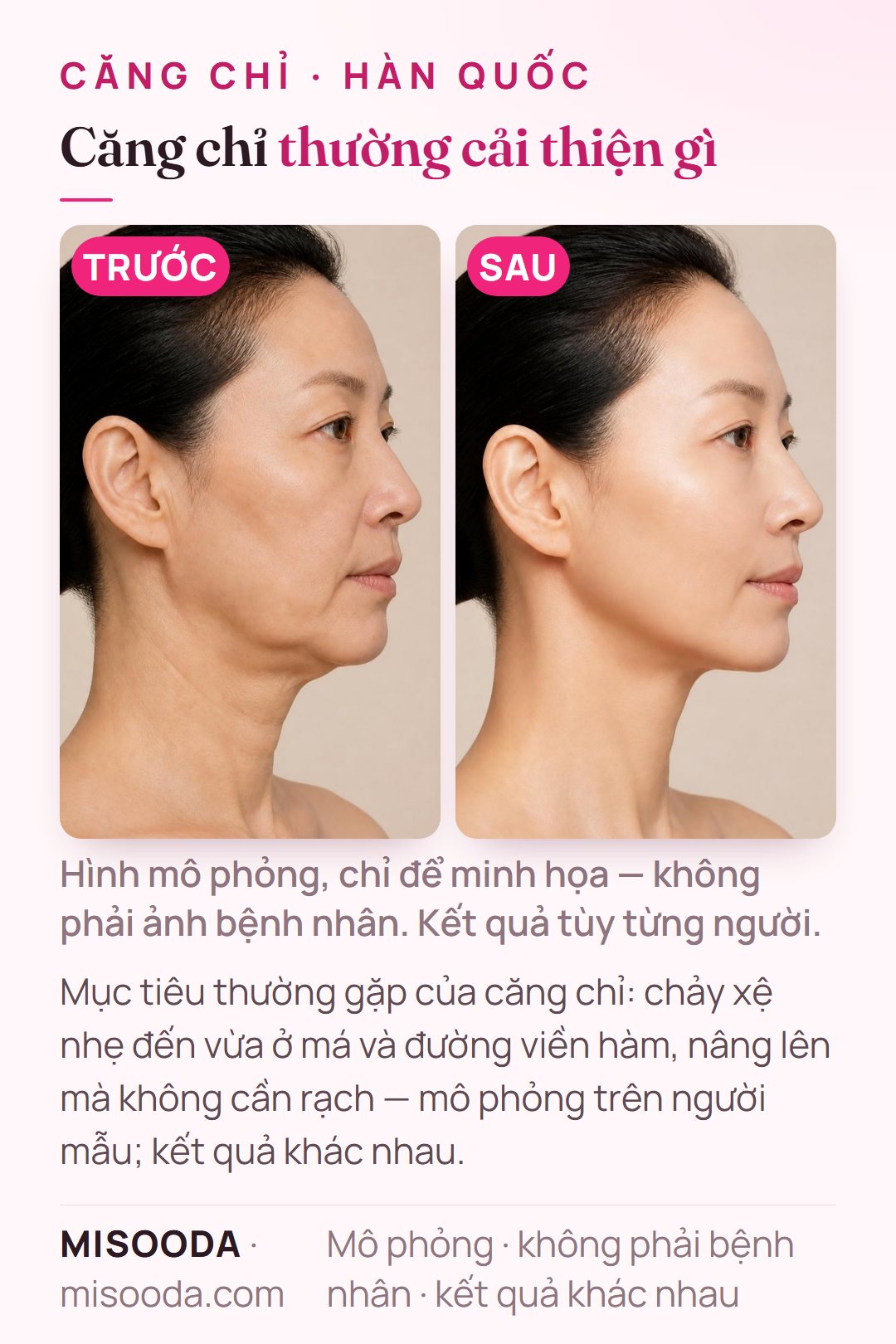 Minh họa mục tiêu thường gặp của căng chỉ tại Hàn Quốc — chảy xệ nhẹ đến vừa ở má và đường viền hàm — mô phỏng trên người mẫu, không phải bệnh nhân