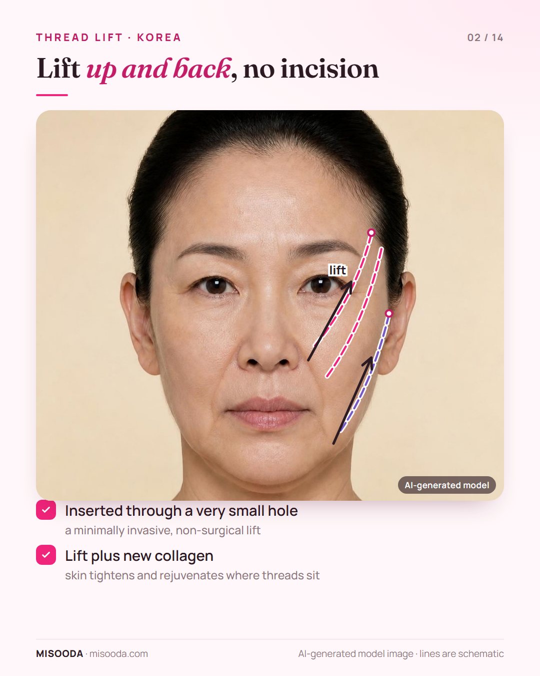 Thread lift vectors on a three-quarter face: threads from the temple and ear pull the cheeks and jowls up and back while stimulating collagen